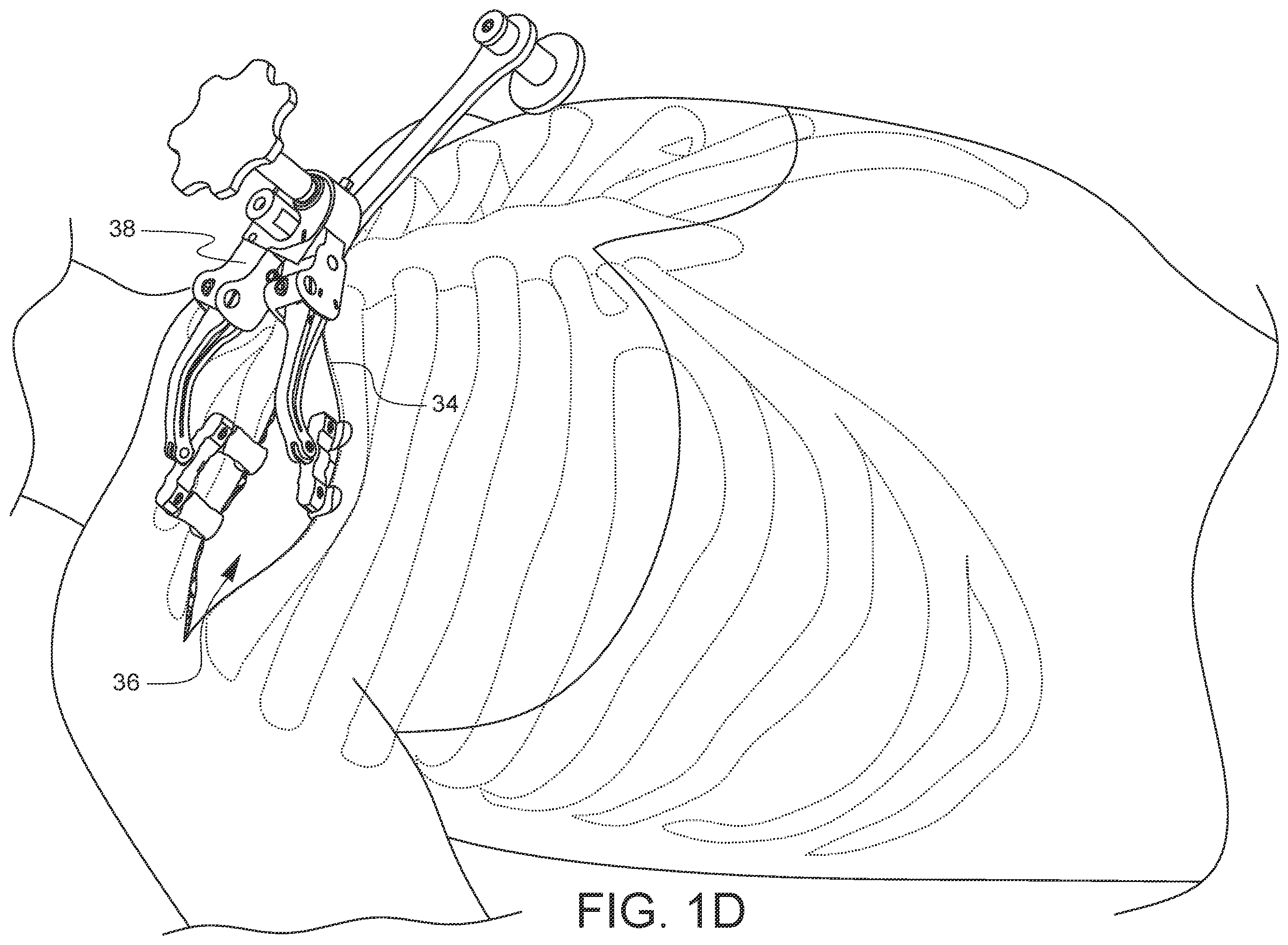 Patent US11812947 Figure 4 – Apparatus for suture management and methods thereof
