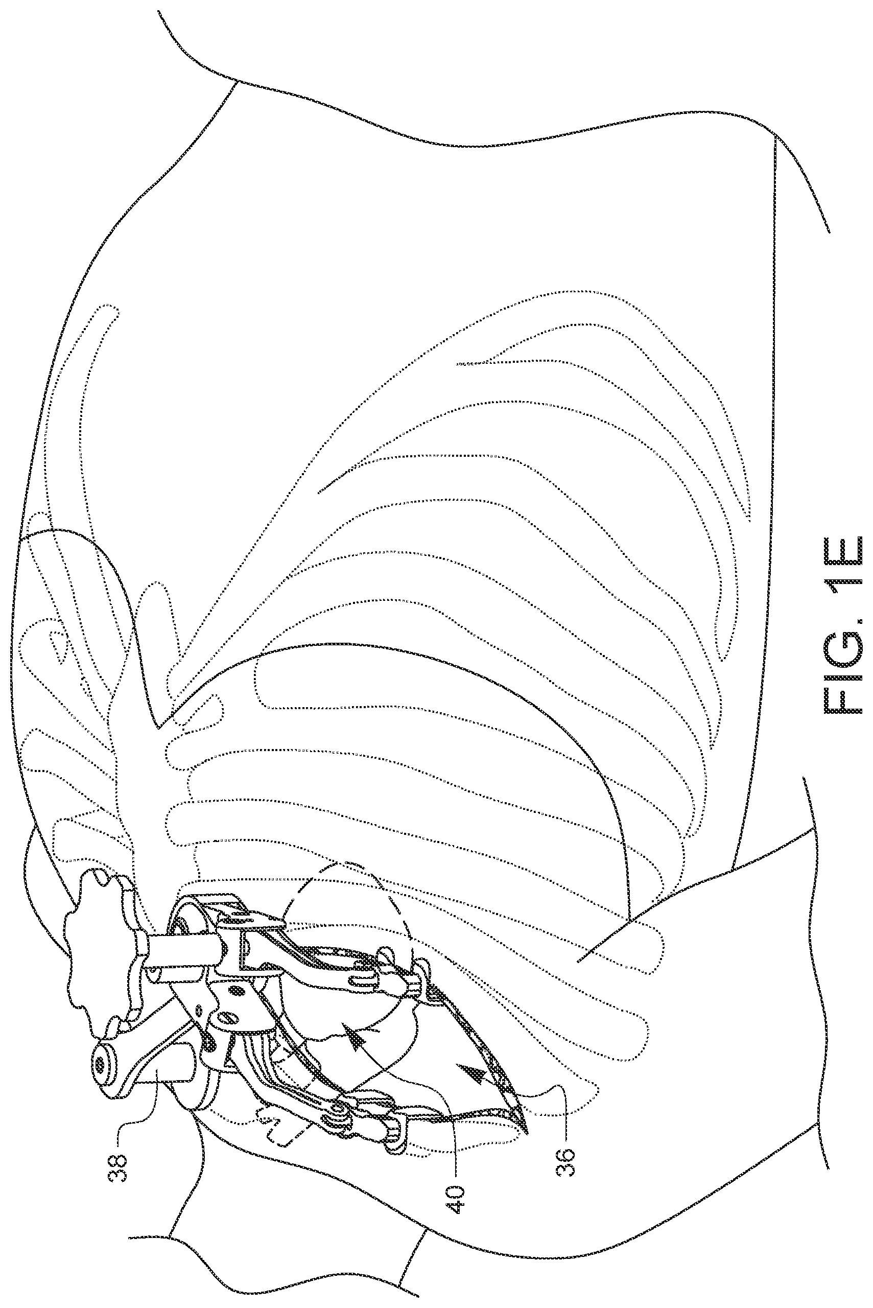 Patent US11812947 Figure 5 – Apparatus for suture management and methods thereof