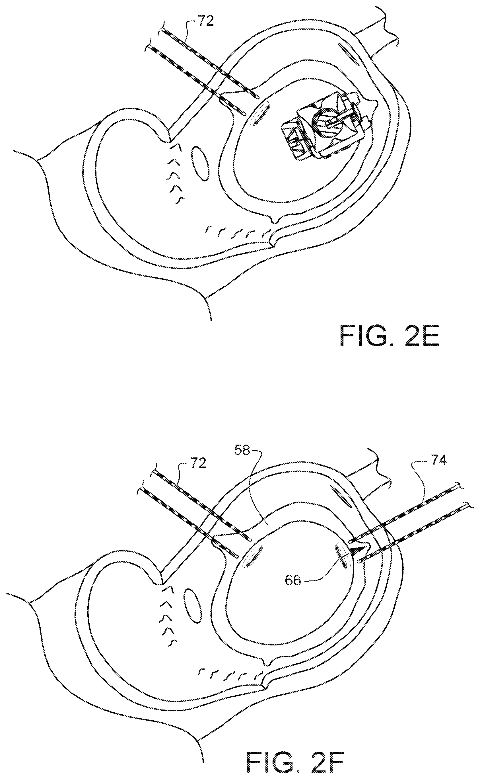 Patent US11812947 Figure 10 – Apparatus for suture management and methods thereof