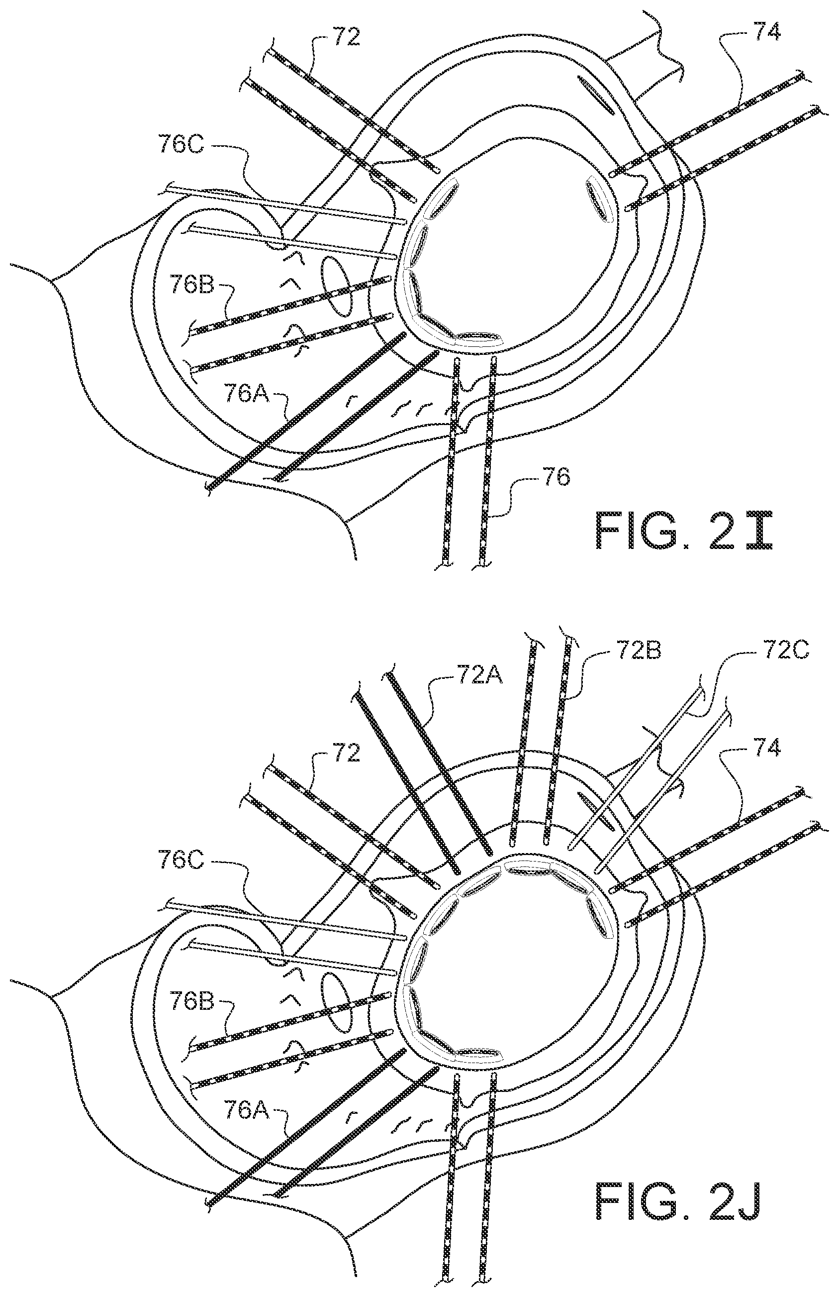 Patent US11812947 Figure 12 – Apparatus for suture management and methods thereof
