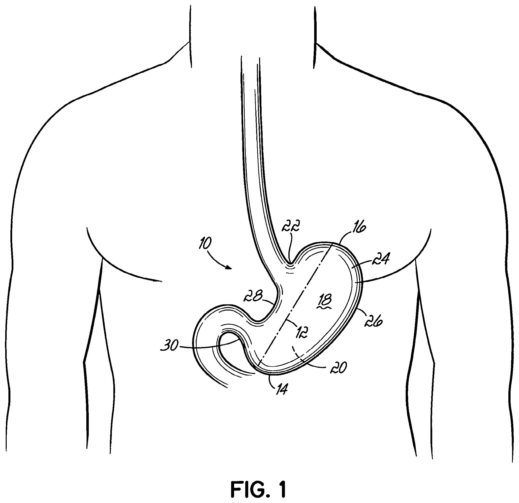 Patent US11812962 — End effectors, surgical stapling devices, and methods of using same — Figure 1