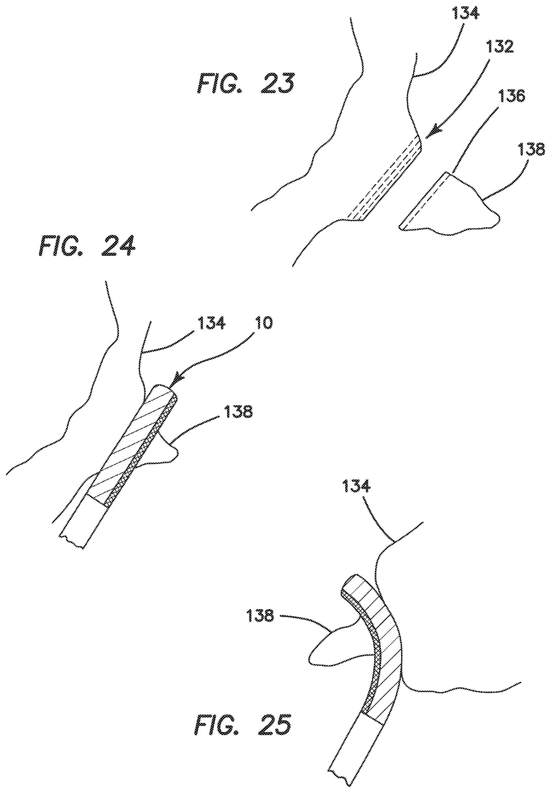 Patent US11812963 Figure 14 – Surgical stapler with partial pockets
