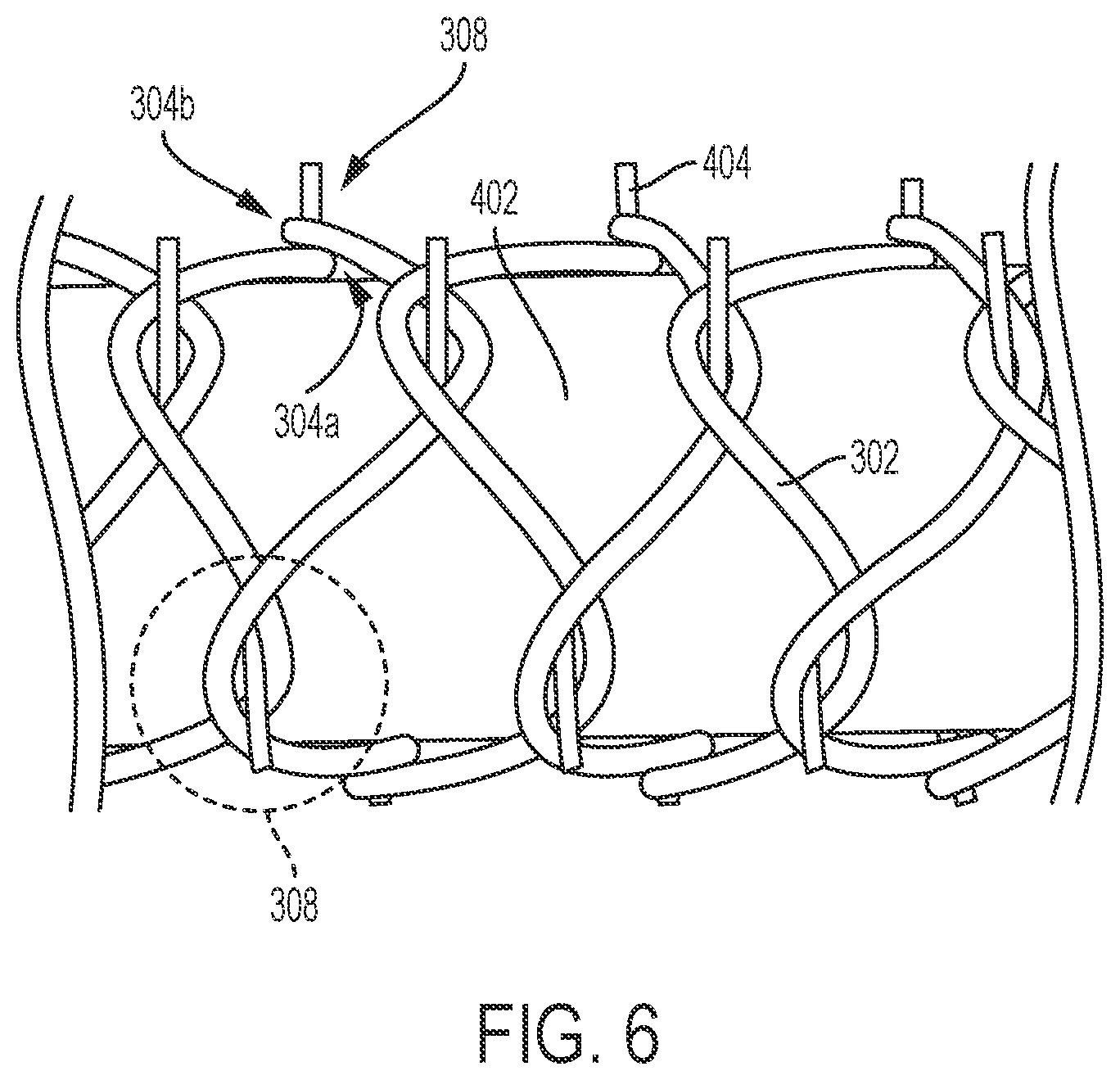 Patent US11812967 Figure 6 – Aneurysm treatment coils and associated systems and methods of use