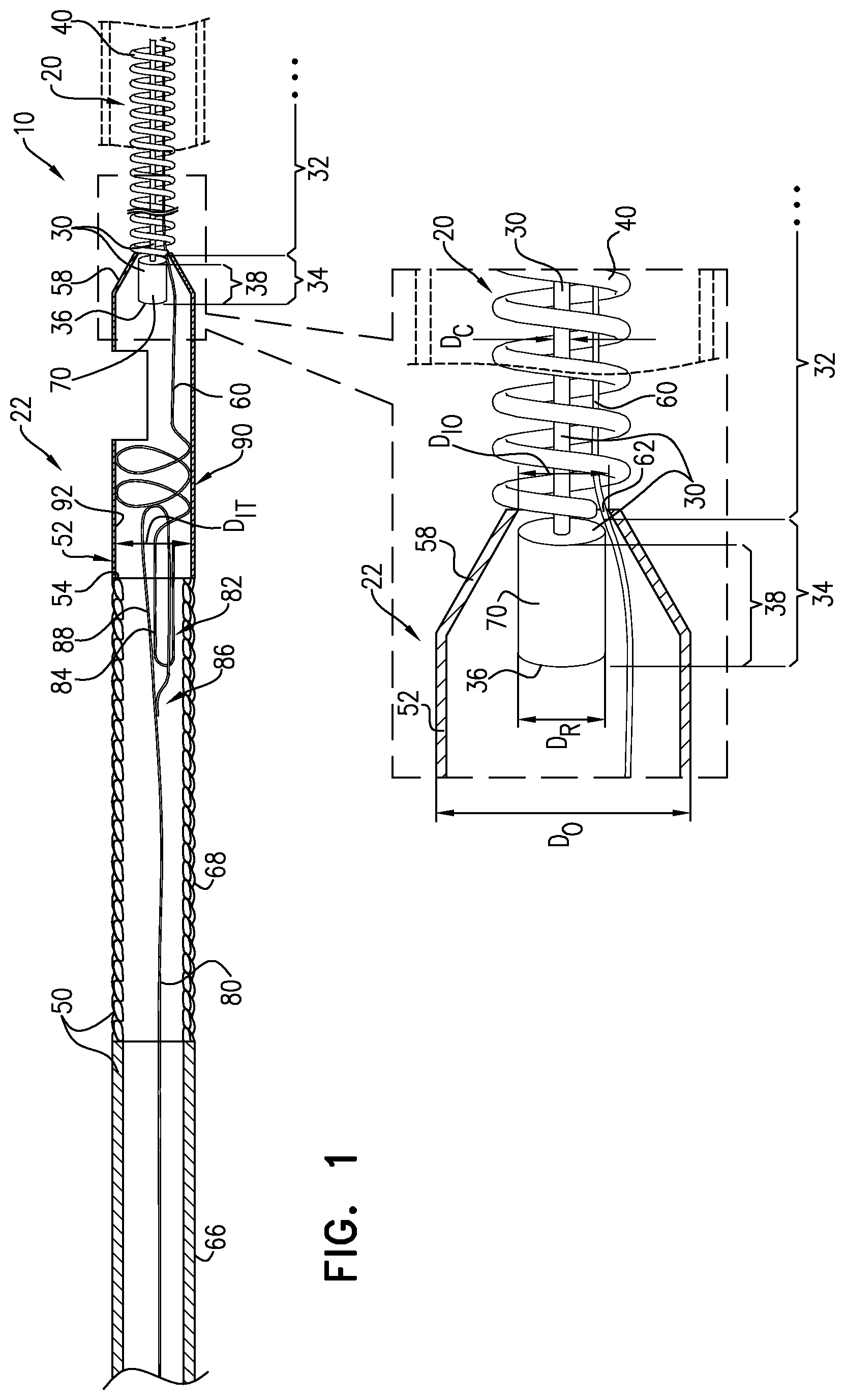 Patent US11812970 — Vascular-malformation implant system — Figure 1