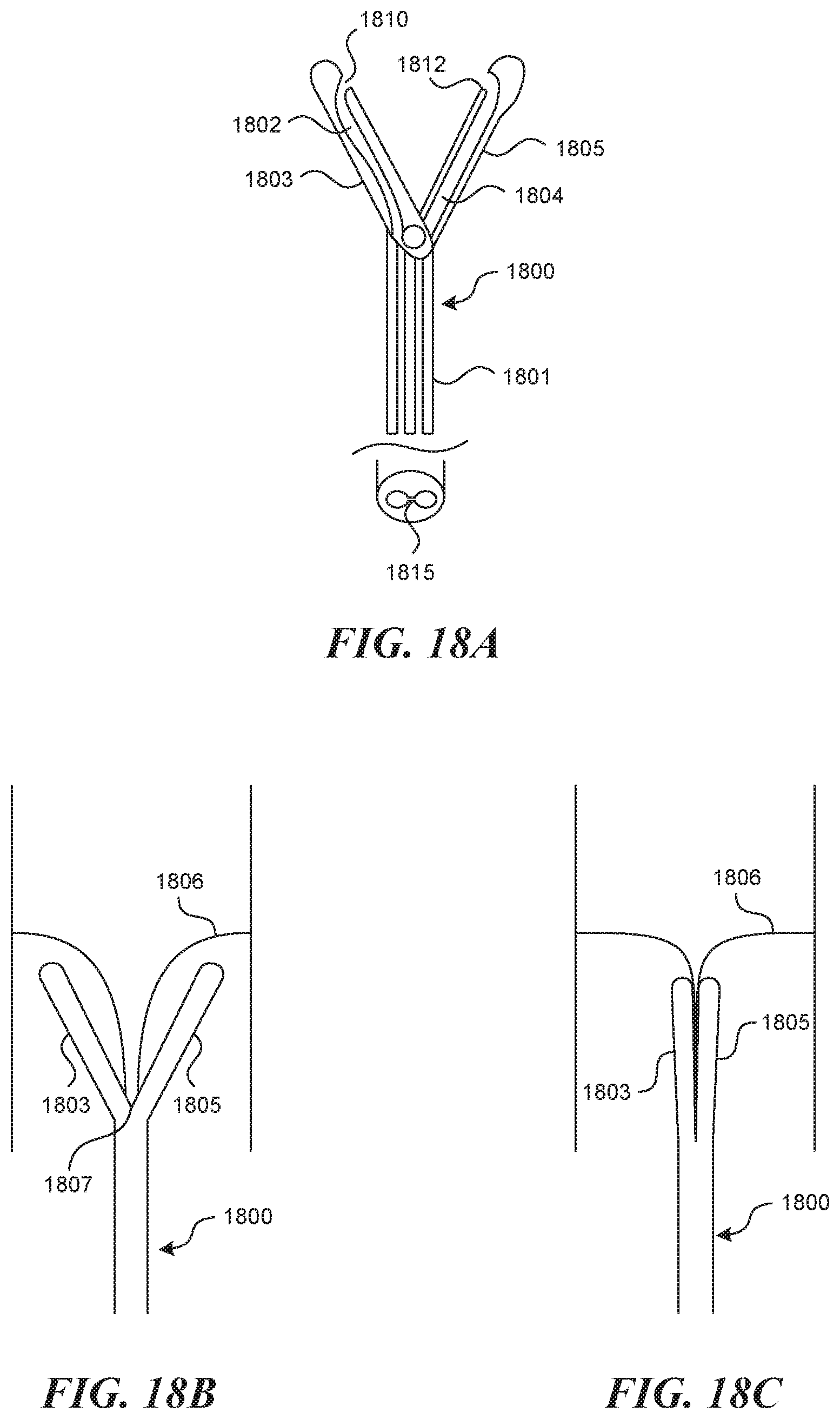 Patent US11812990 Figure 17 – Systems and methods for endoluminal valve creation