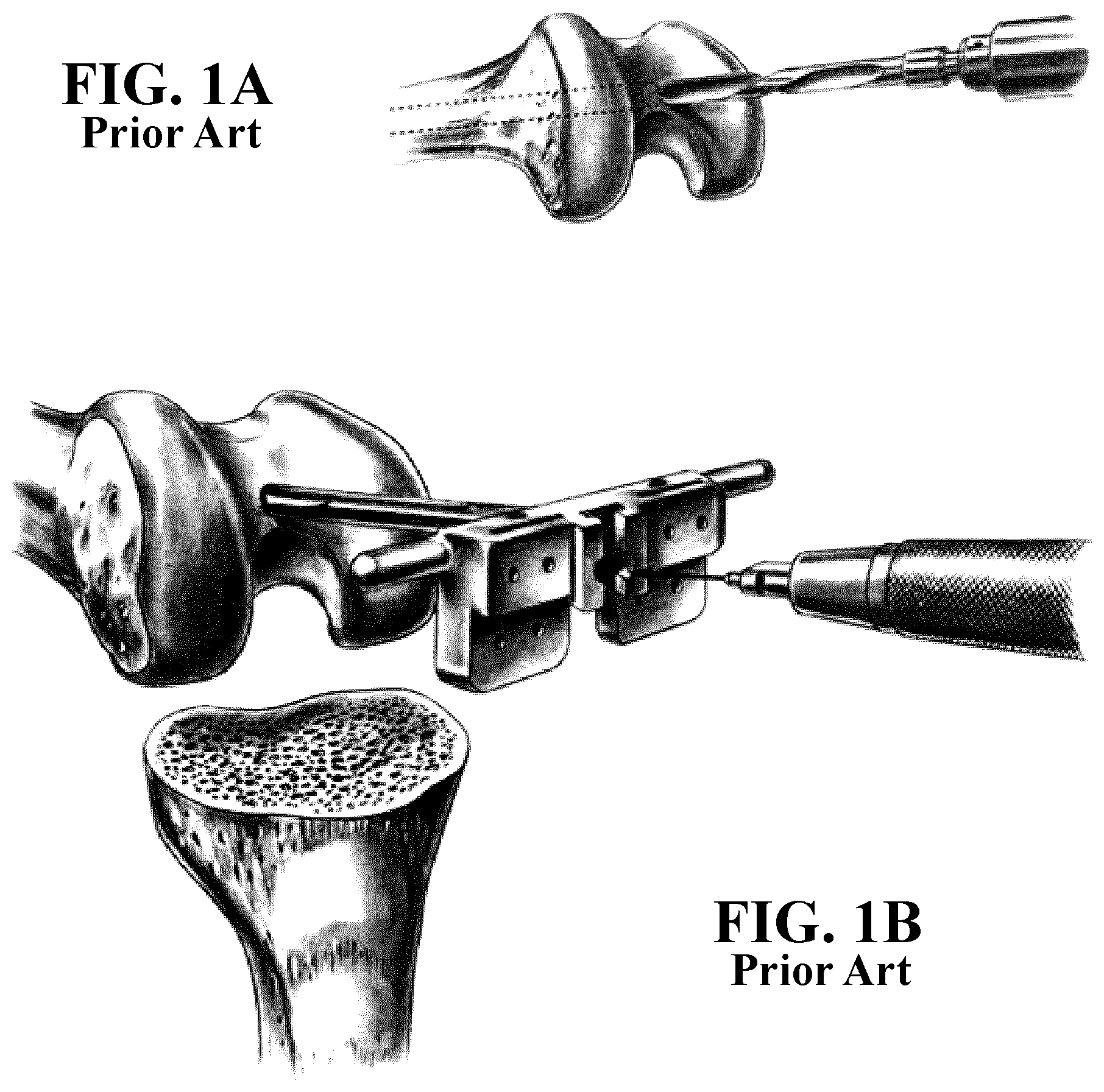 Patent US11812996 — Plug for bone tissue — Figure 1