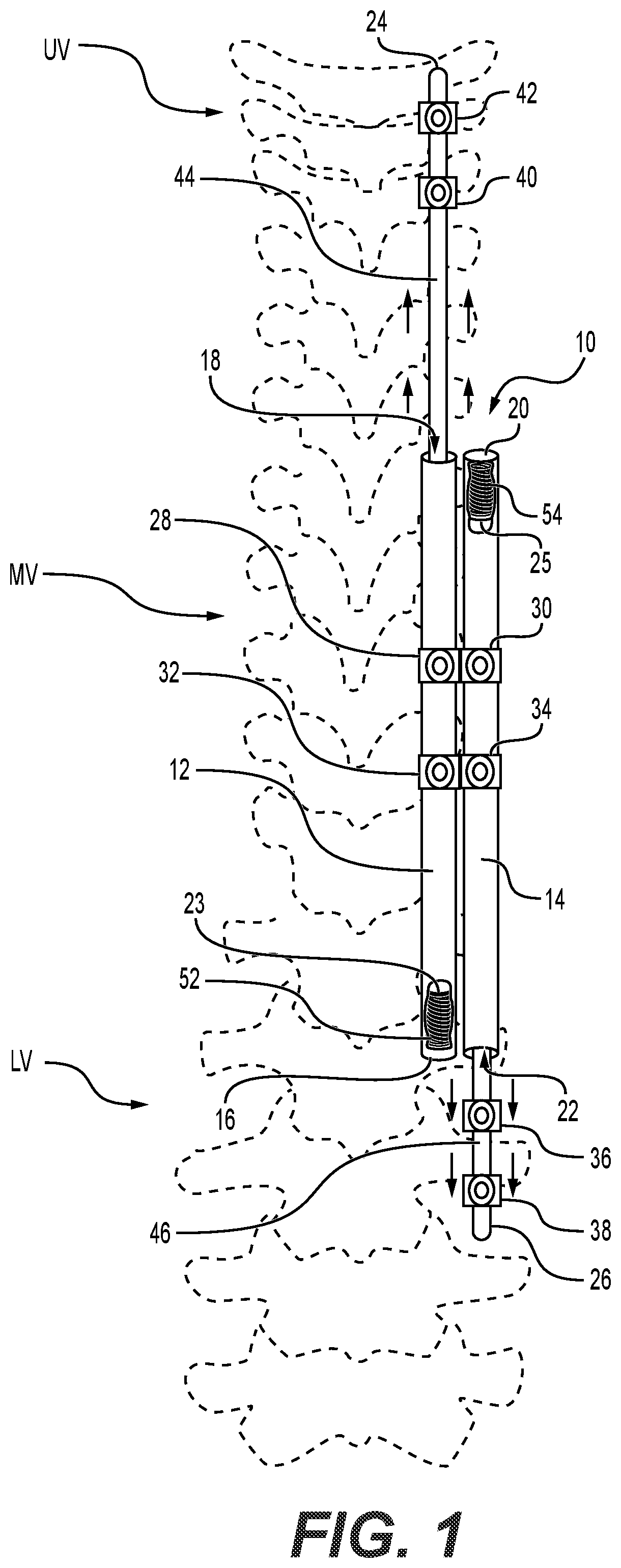 Patent US11812997 — System and method for treating early onset scoliosis — Figure 1