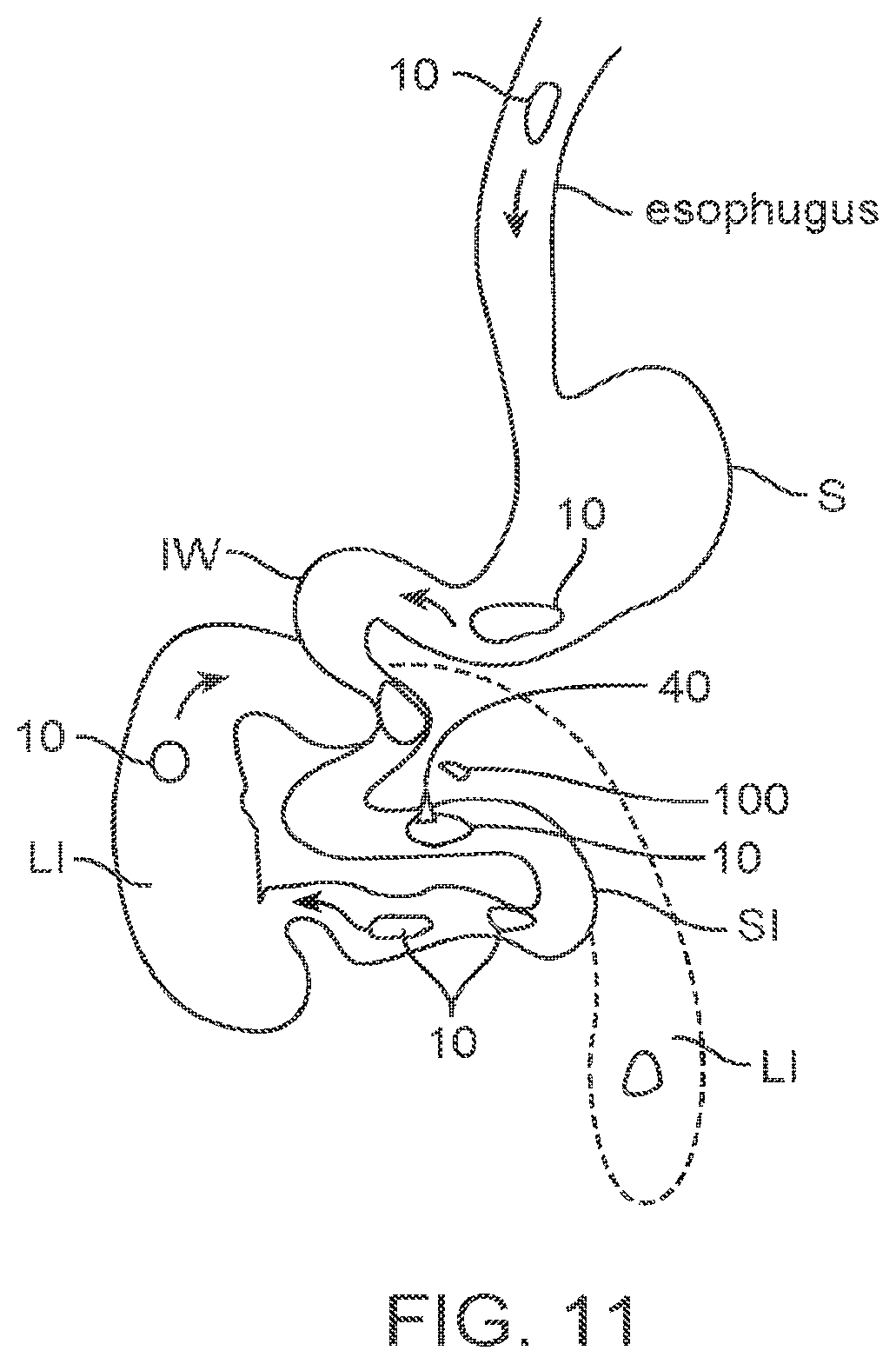 Patent US11814427 Figure 17 – Therapeutic agent preparations for delivery into a lumen of the intestinal tract using a swallowable drug delivery device