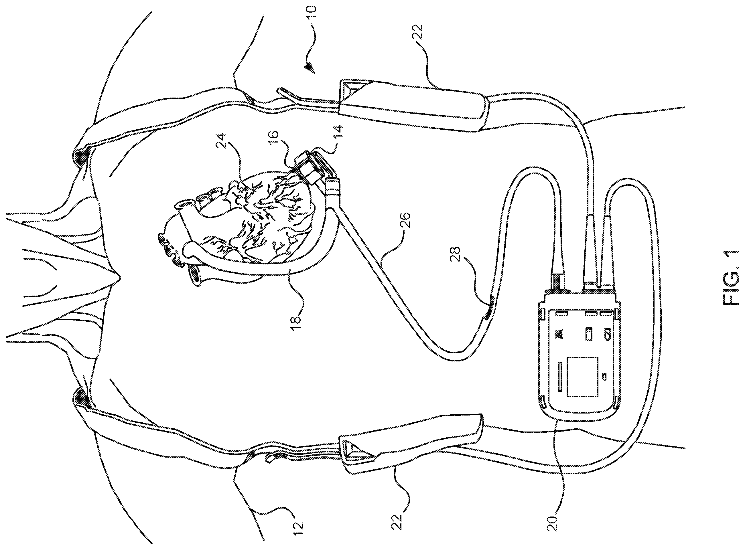 Patent US11824381 — Blood pump controllers having daisy-chained batteries — Figure 1