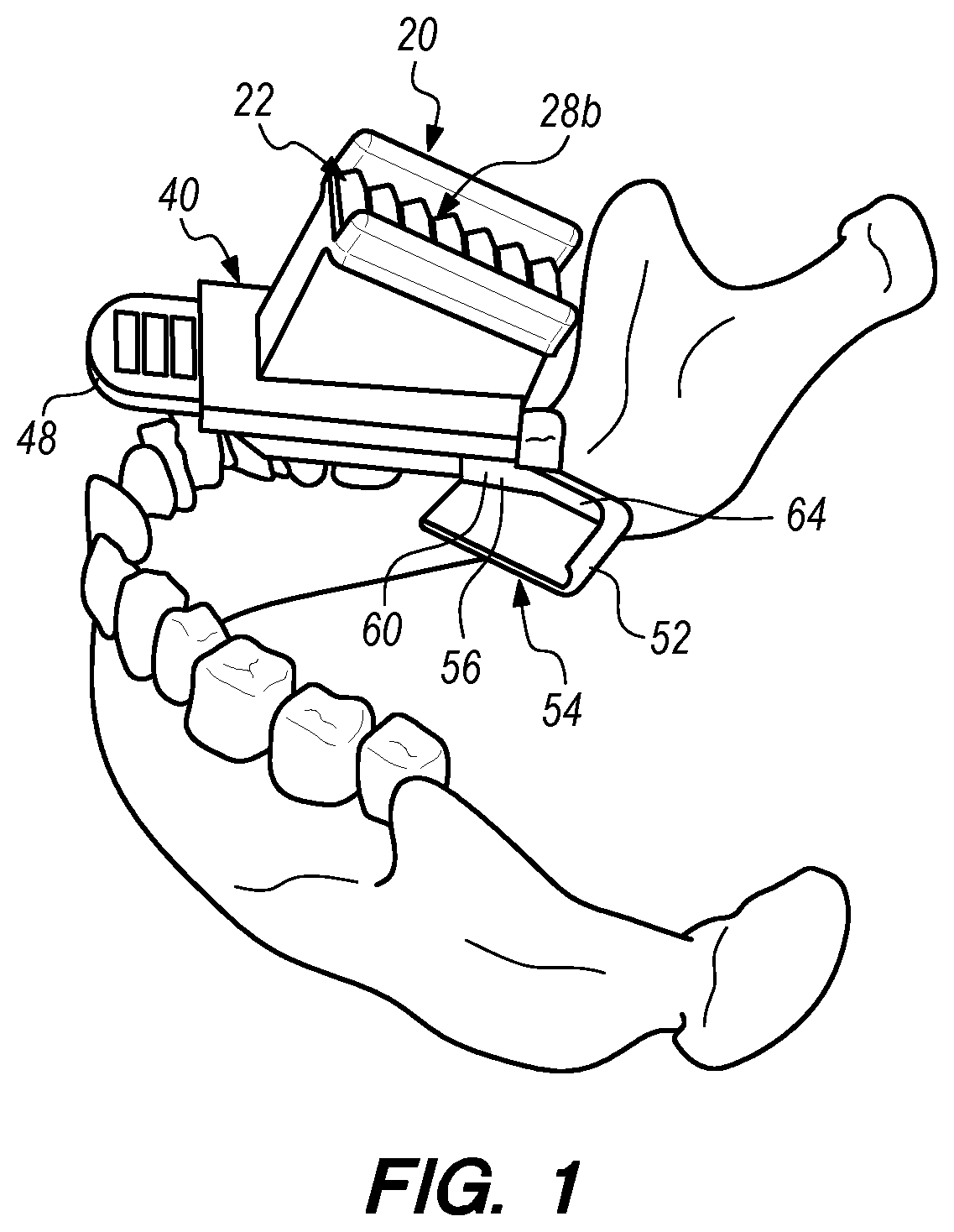 Patent US12090019 — Bite block with a needle alignment attachment system — Figure 1