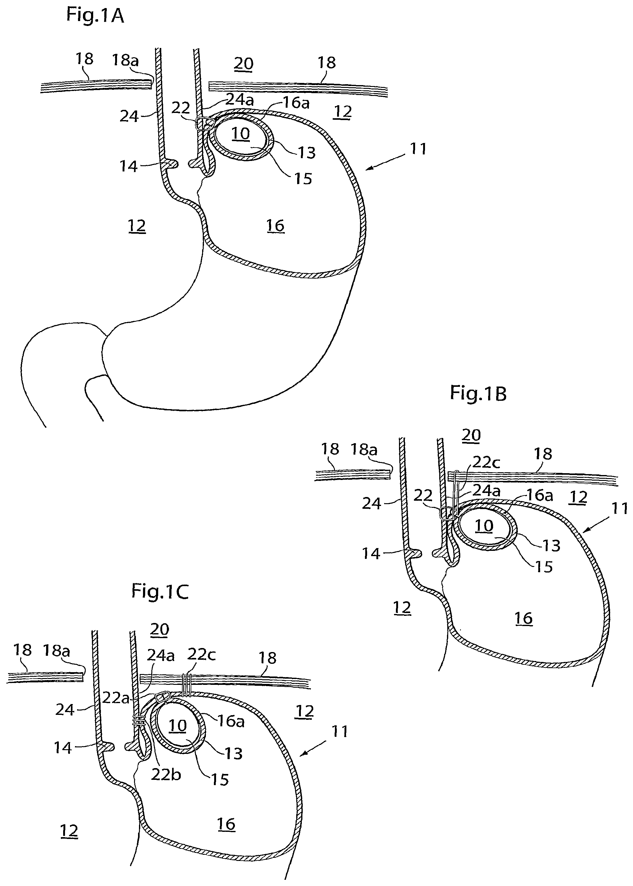 Patent US12090037 — Apparatus for treating obesity and reflux disease — Figure 1