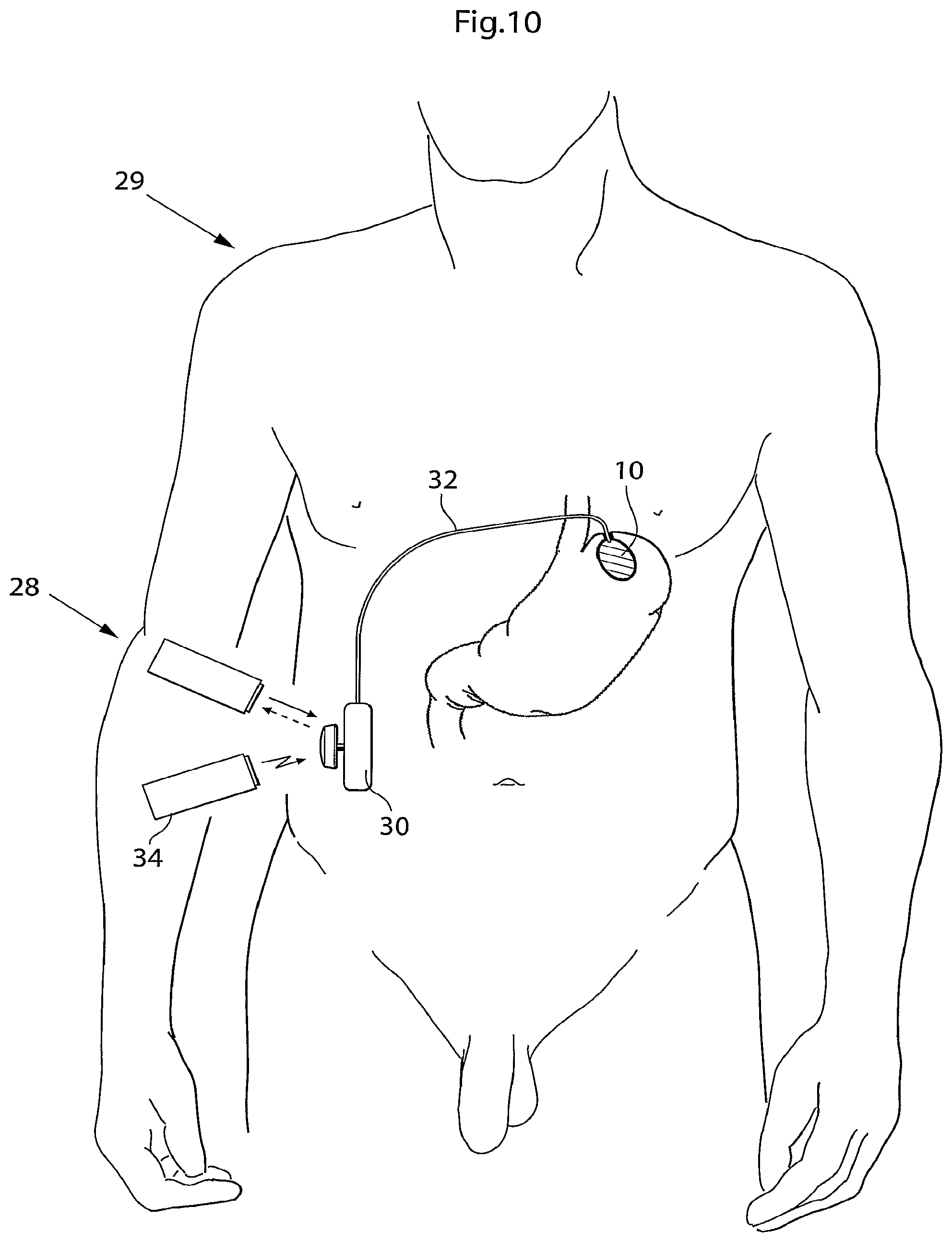 Patent US12090037 Figure 8 – Apparatus for treating obesity and reflux disease