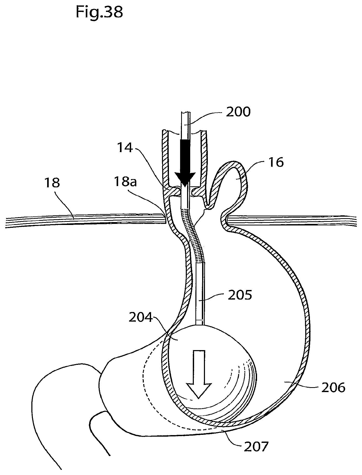 Patent US12090037 Figure 20 – Apparatus for treating obesity and reflux disease