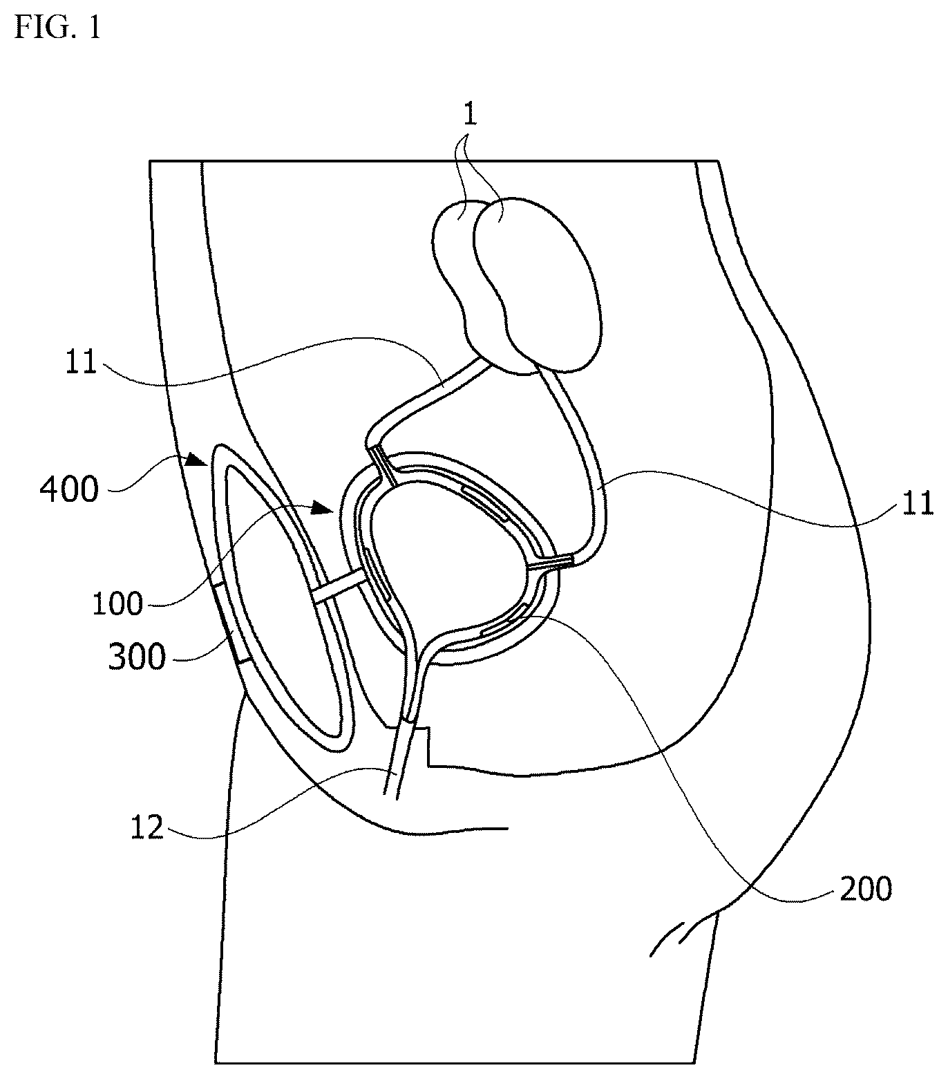 Patent US12090039 — Biomimetic artificial bladder and method for controlling same — Figure 1