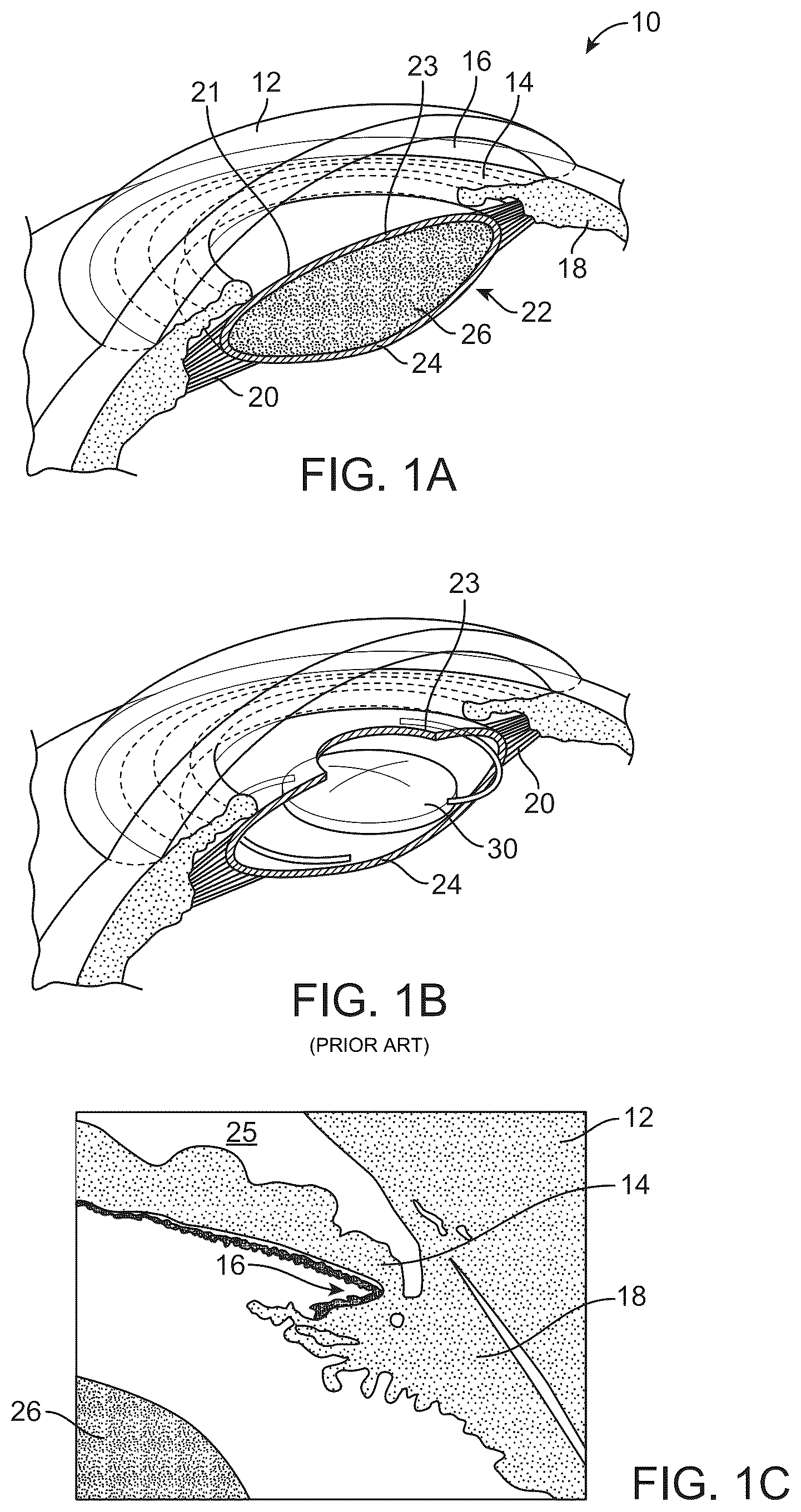 Patent US12090044 — Accommodating intraocular lens — Figure 1