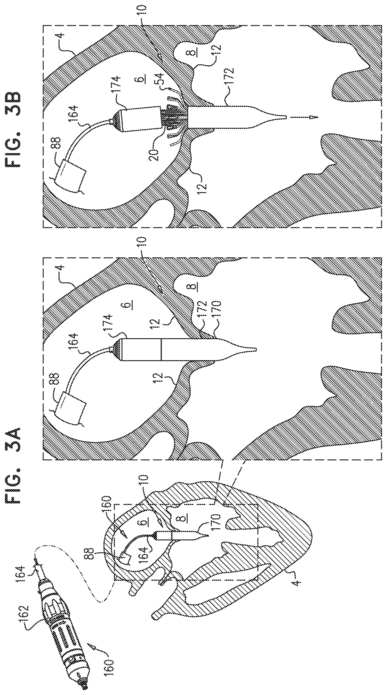 Patent US12090048 Figure 5 – Prosthetic heart valve