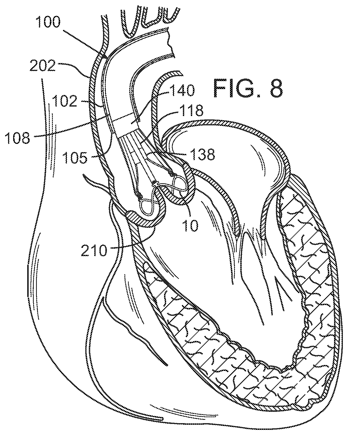 Patent US12090049 Figure 4 – Retaining mechanisms for prosthetic valves