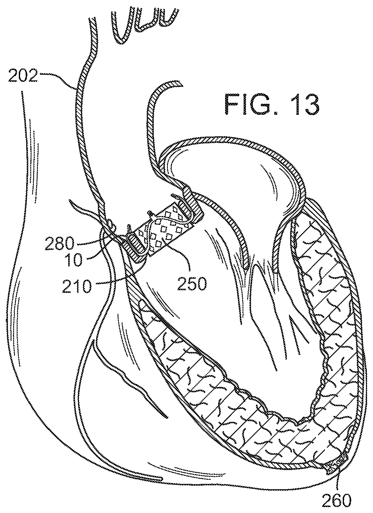 Patent US12090049 Figure 9 – Retaining mechanisms for prosthetic valves