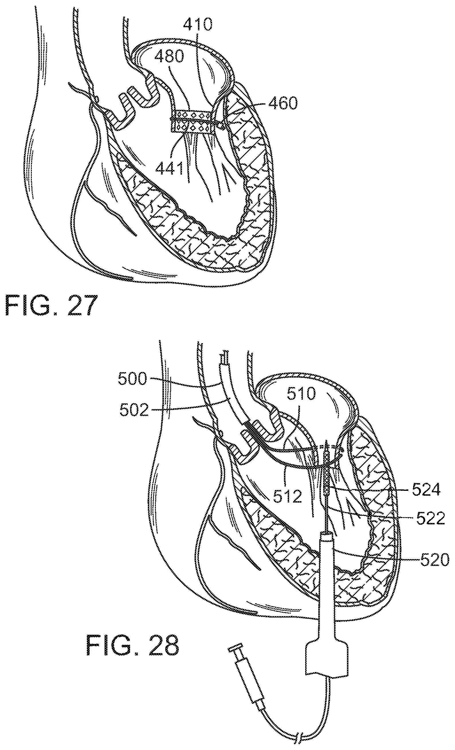 Patent US12090049 Figure 15 – Retaining mechanisms for prosthetic valves