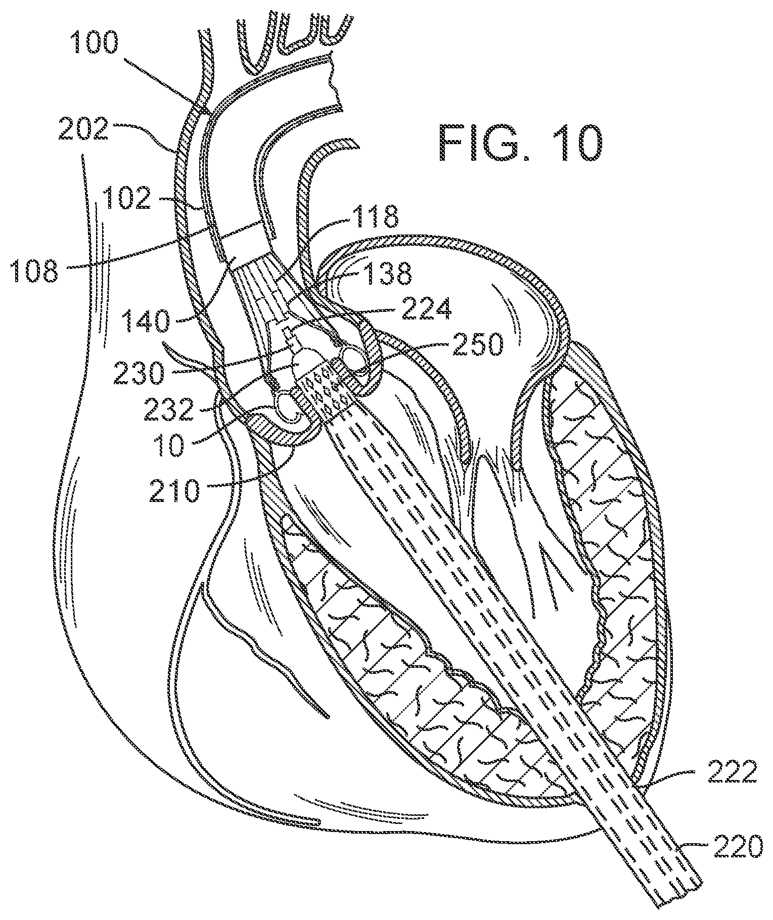 Patent US12090050 Figure 6 – Method for delivering a support member to a native heart valve