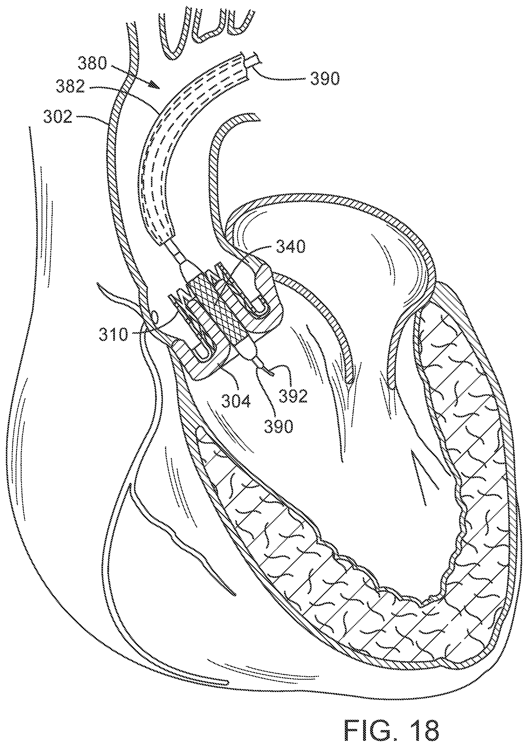 Patent US12090050 Figure 12 – Method for delivering a support member to a native heart valve