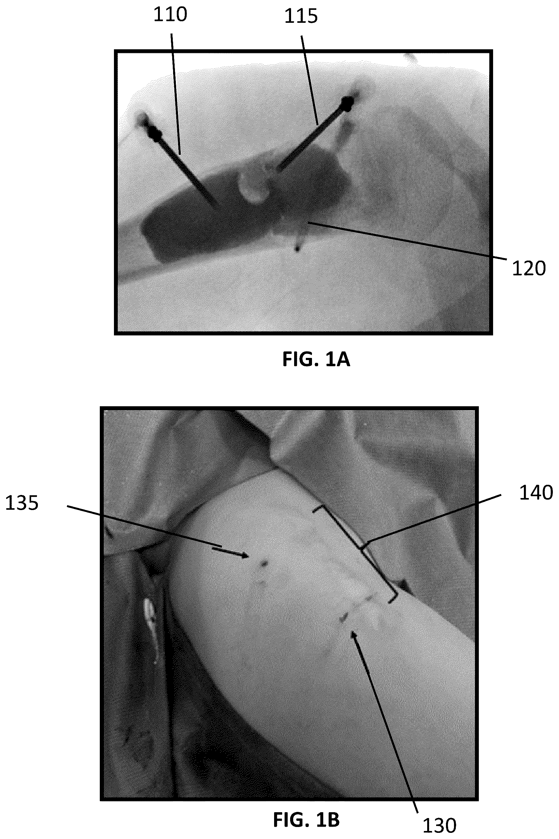 Patent US12090065 — System and method for treatment of bone — Figure 1