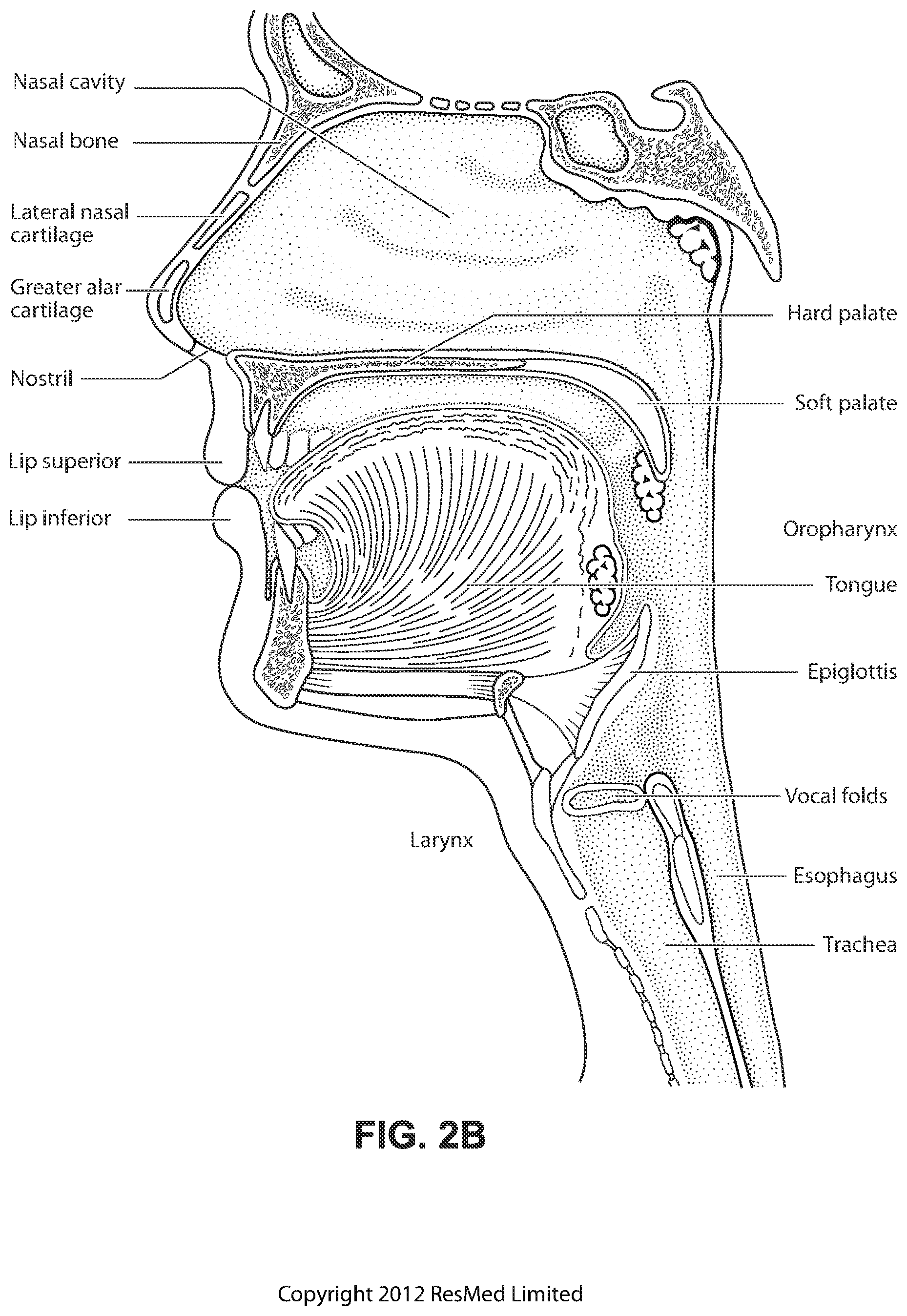 Patent US12090275 Figure 5 – Patient interface