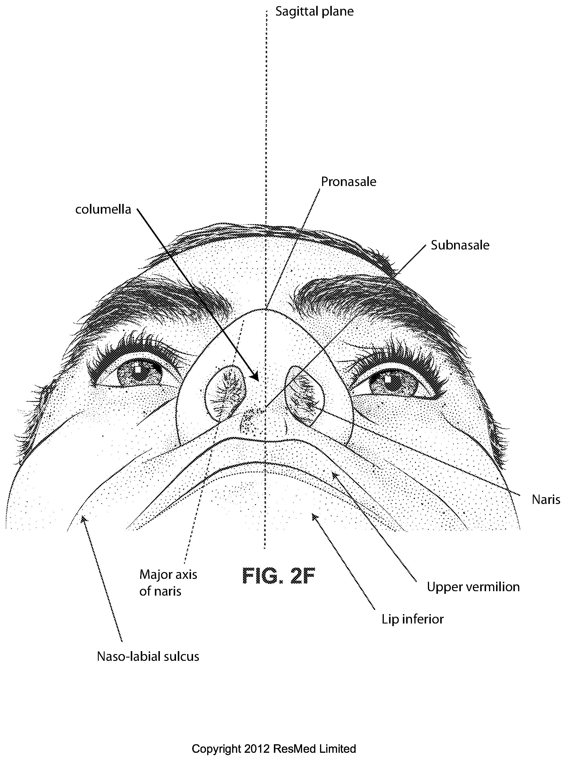 Patent US12090275 Figure 9 – Patient interface
