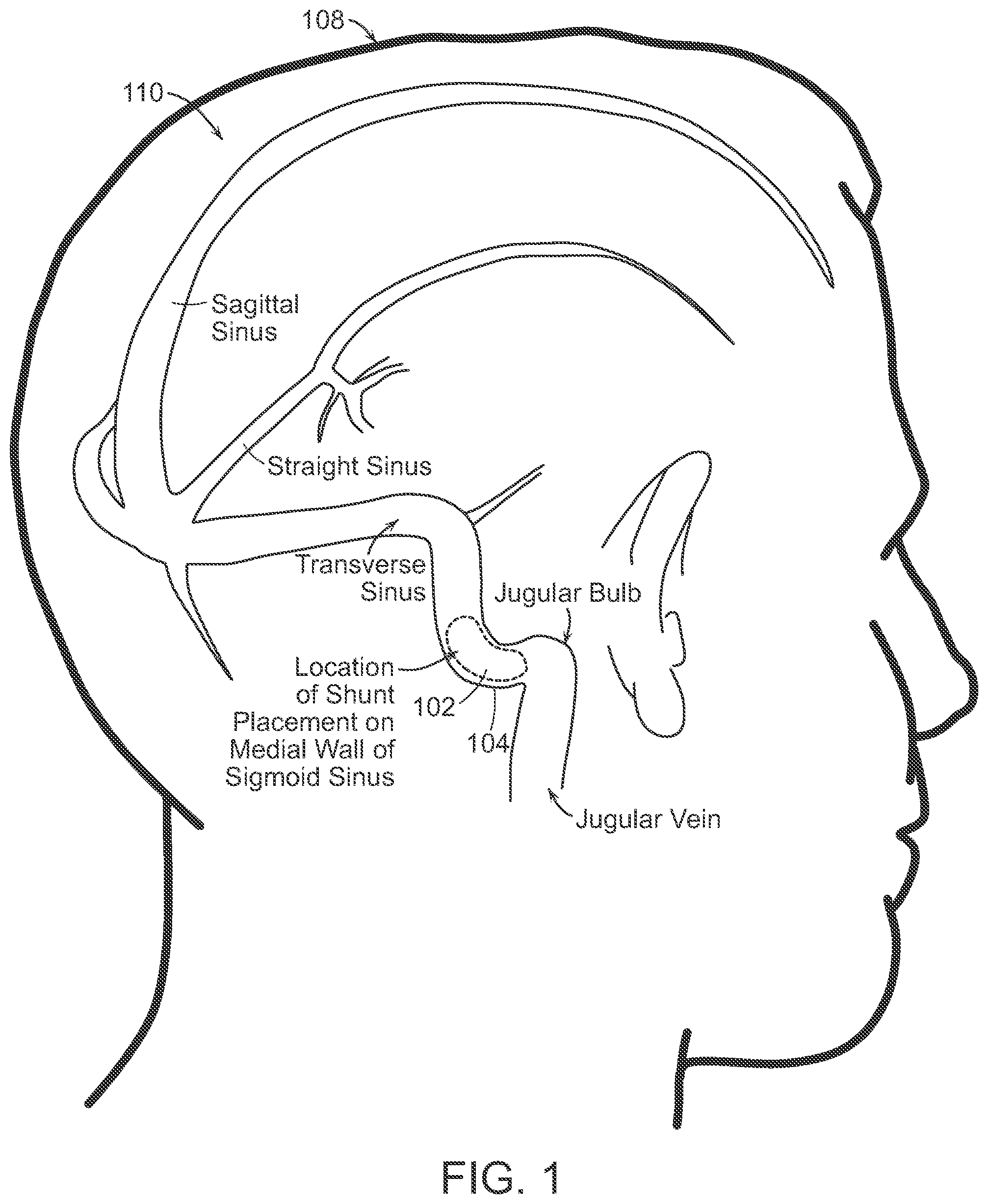 Patent US12090291 — Endovascular cerebrospinal fluid shunt — Figure 1