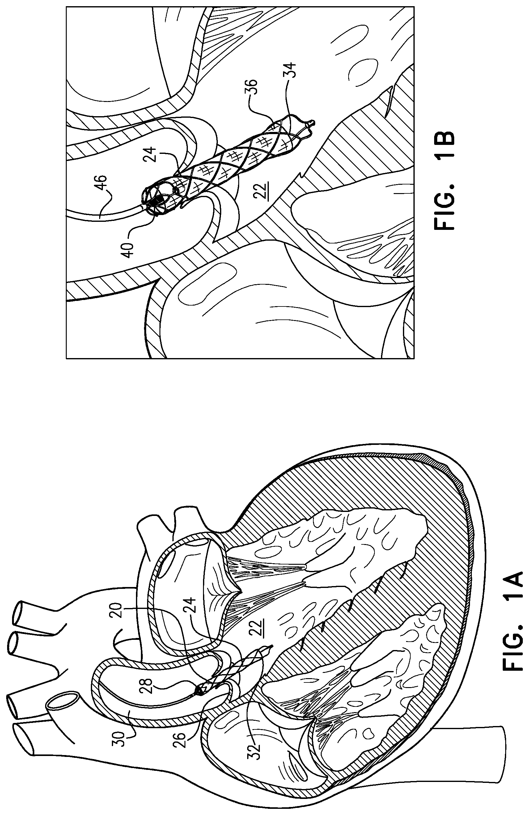 Patent US12090314 — Ventricular assist device — Figure 1
