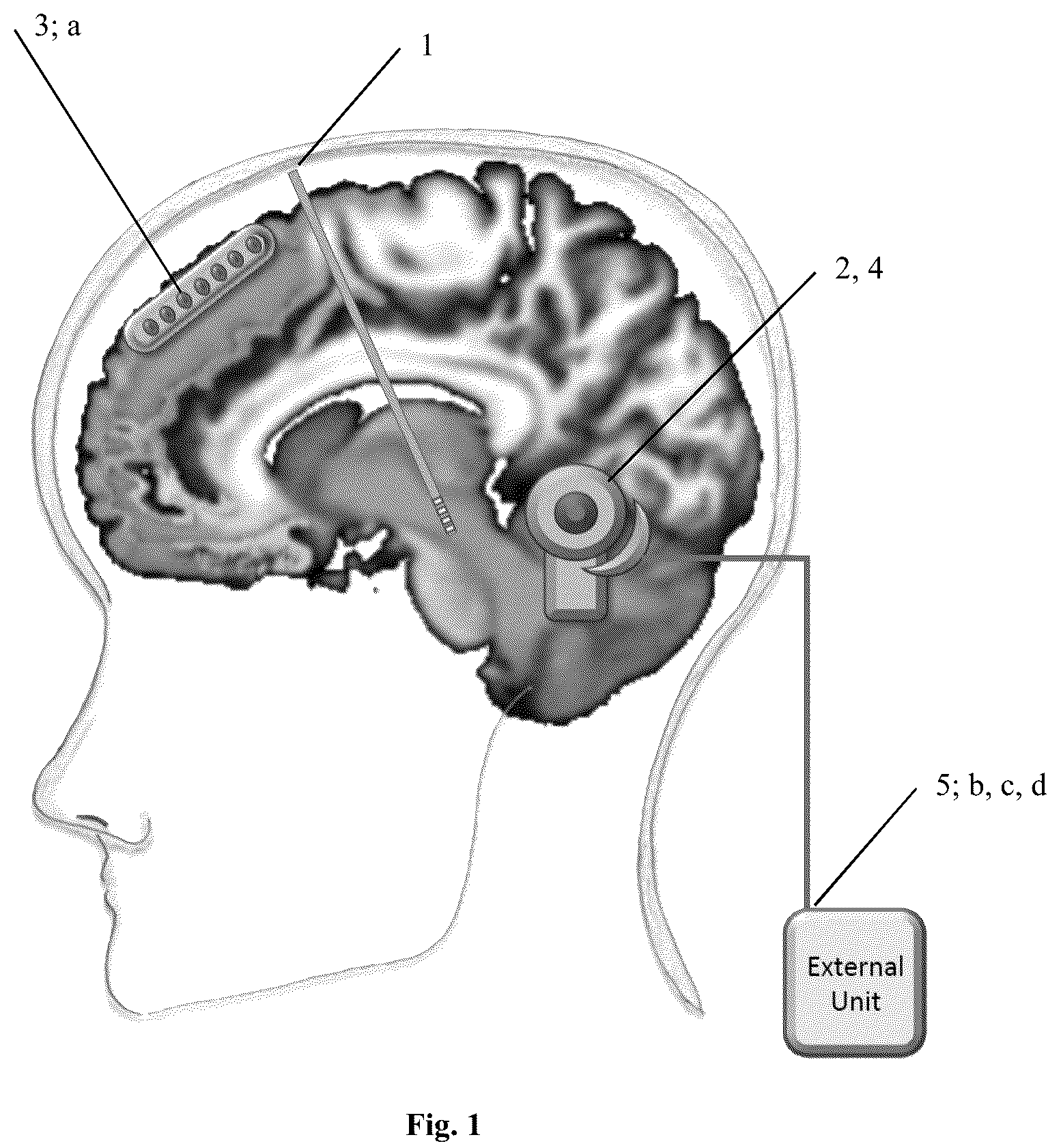 Patent US12090317 — Adaptive deep brain stimulation of the superolateral medial forebrain bundle — Figure 1