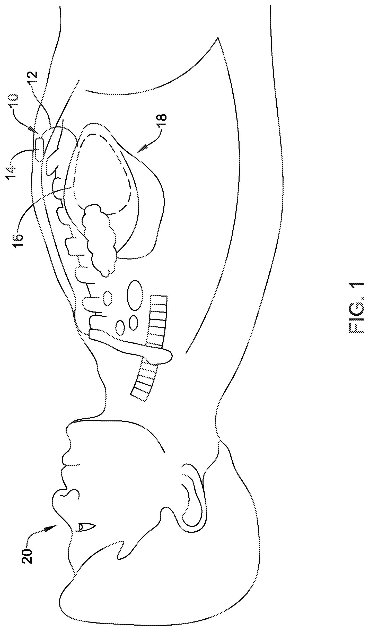 Patent US12090319 — Implantable medical devices and methods for making and delivering implantable medical devices — Figure 1