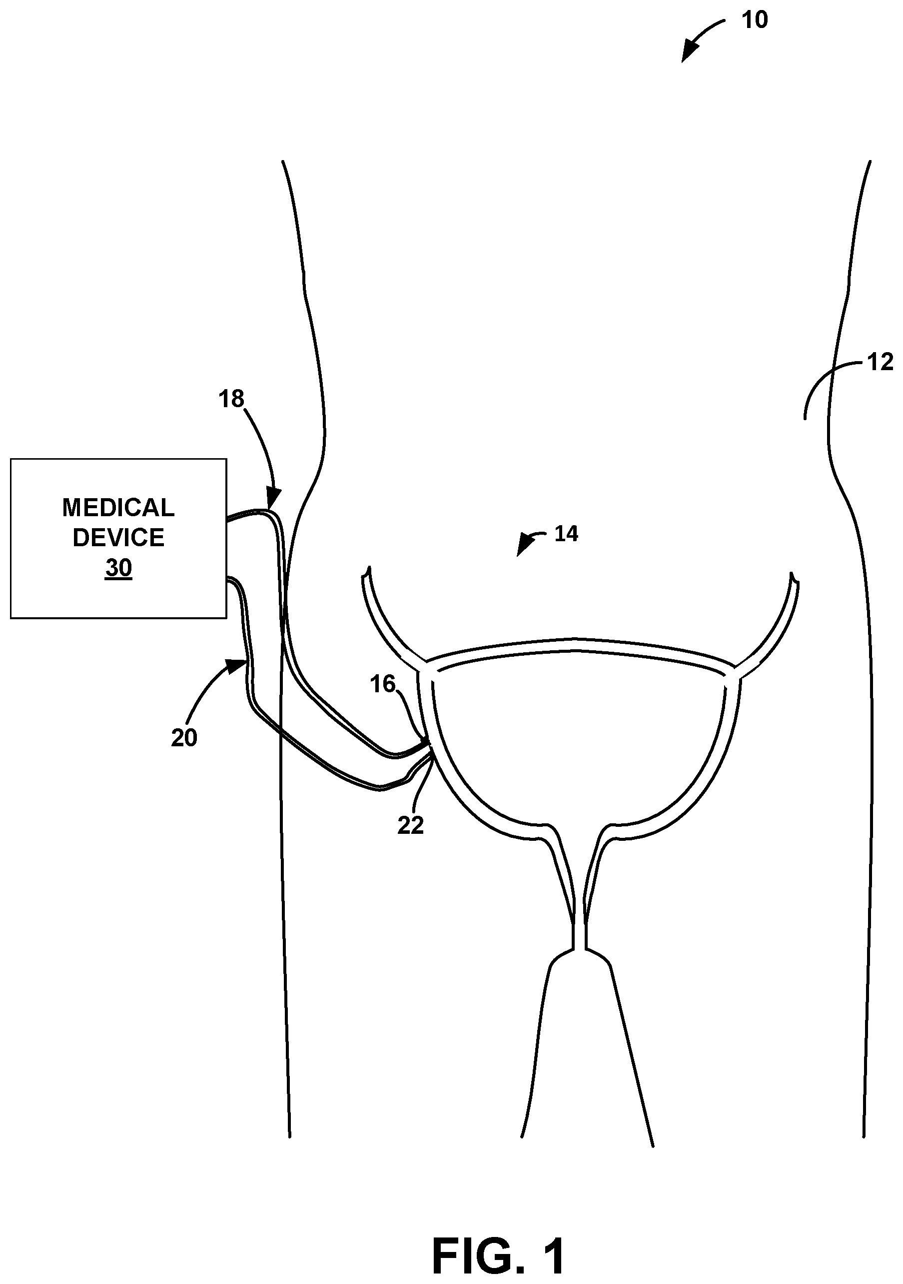 Patent US12090321 — Lead placement for nerve stimulation — Figure 1