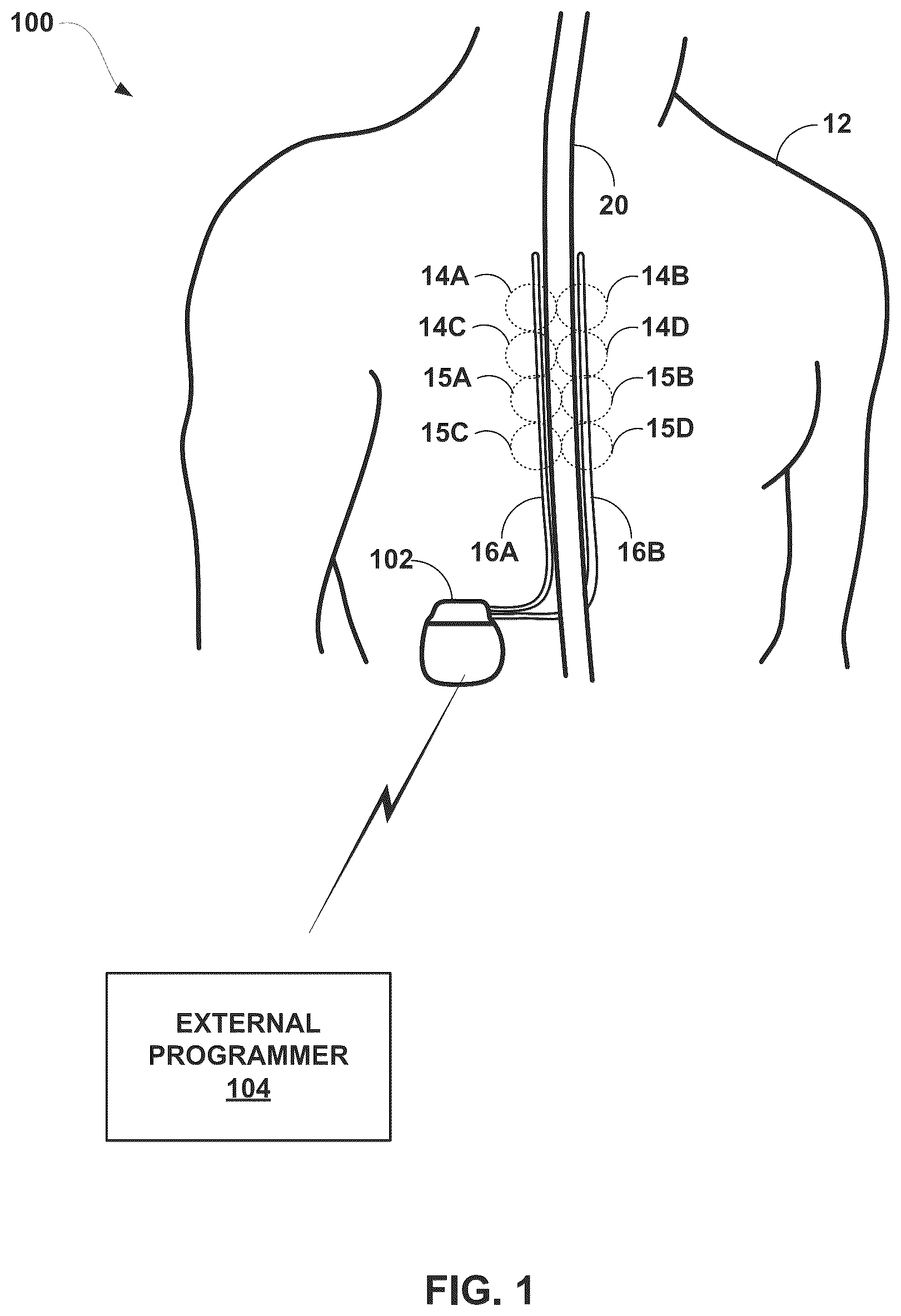 Patent US12090325 — Management of electrical stimulation therapy — Figure 1