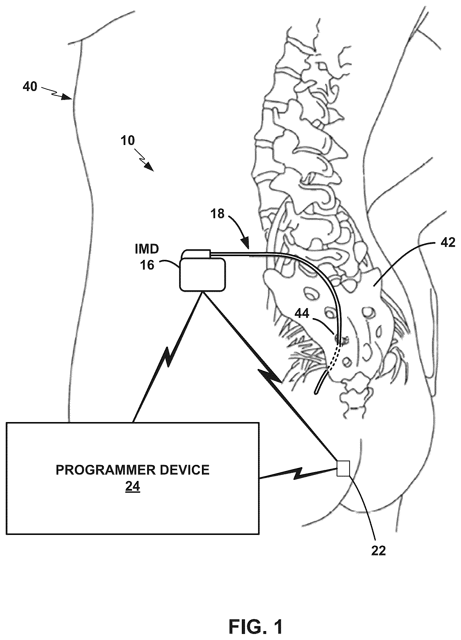 Patent US12090326 — Stimulation vector selection using pulse width data — Figure 1