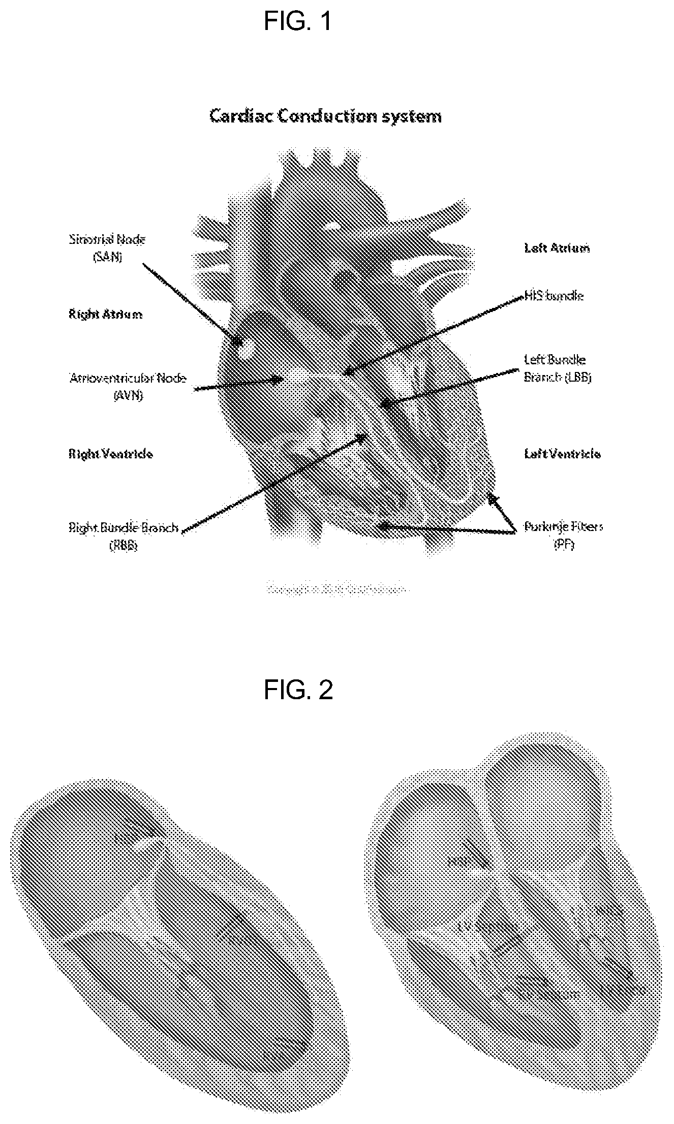 Patent US12090329 — Pacemaker lead for cerclage pacing — Figure 1
