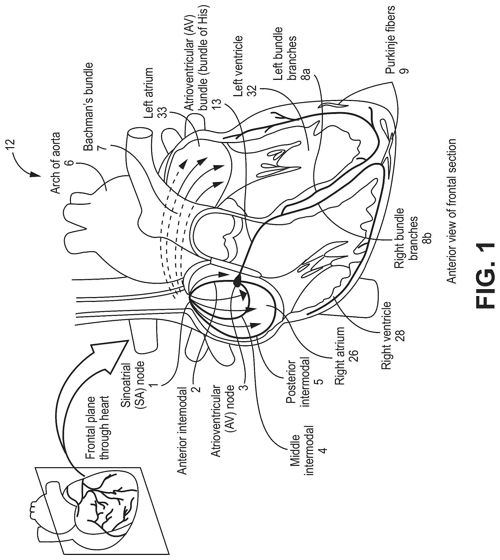 Patent US12090330 — Bundle branch pacing devices and methods — Figure 1