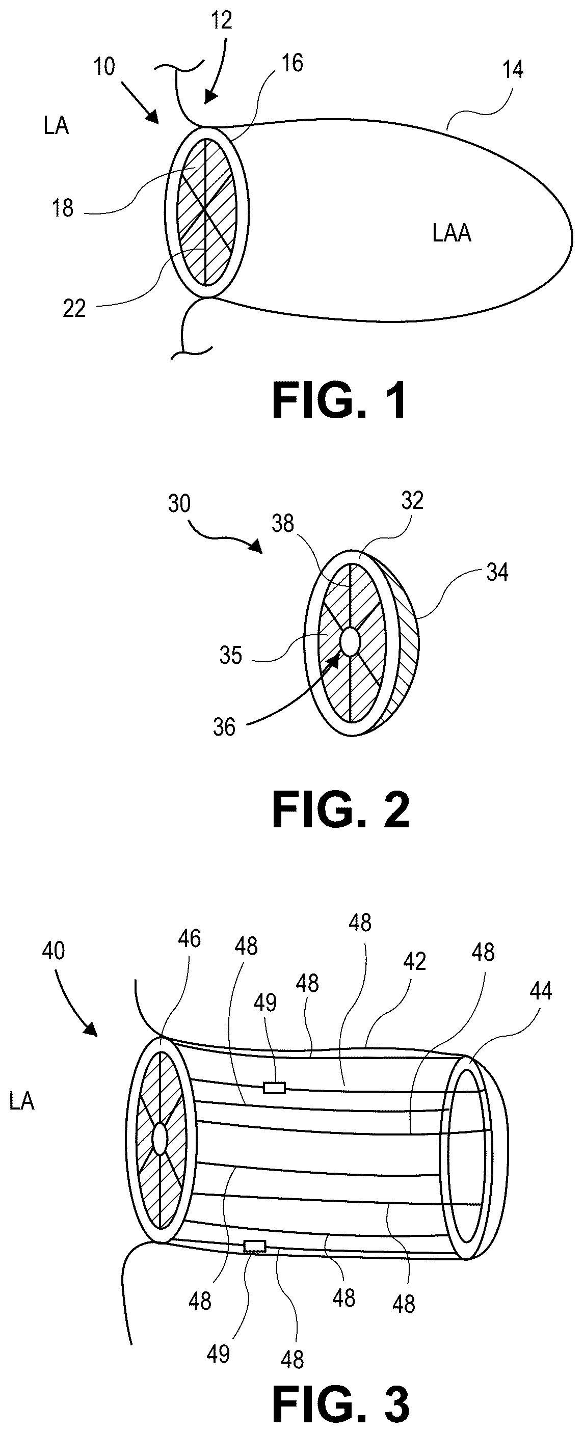 Patent US12090331 — Atrial appendage occlusion and arrhythmia treatment — Figure 1