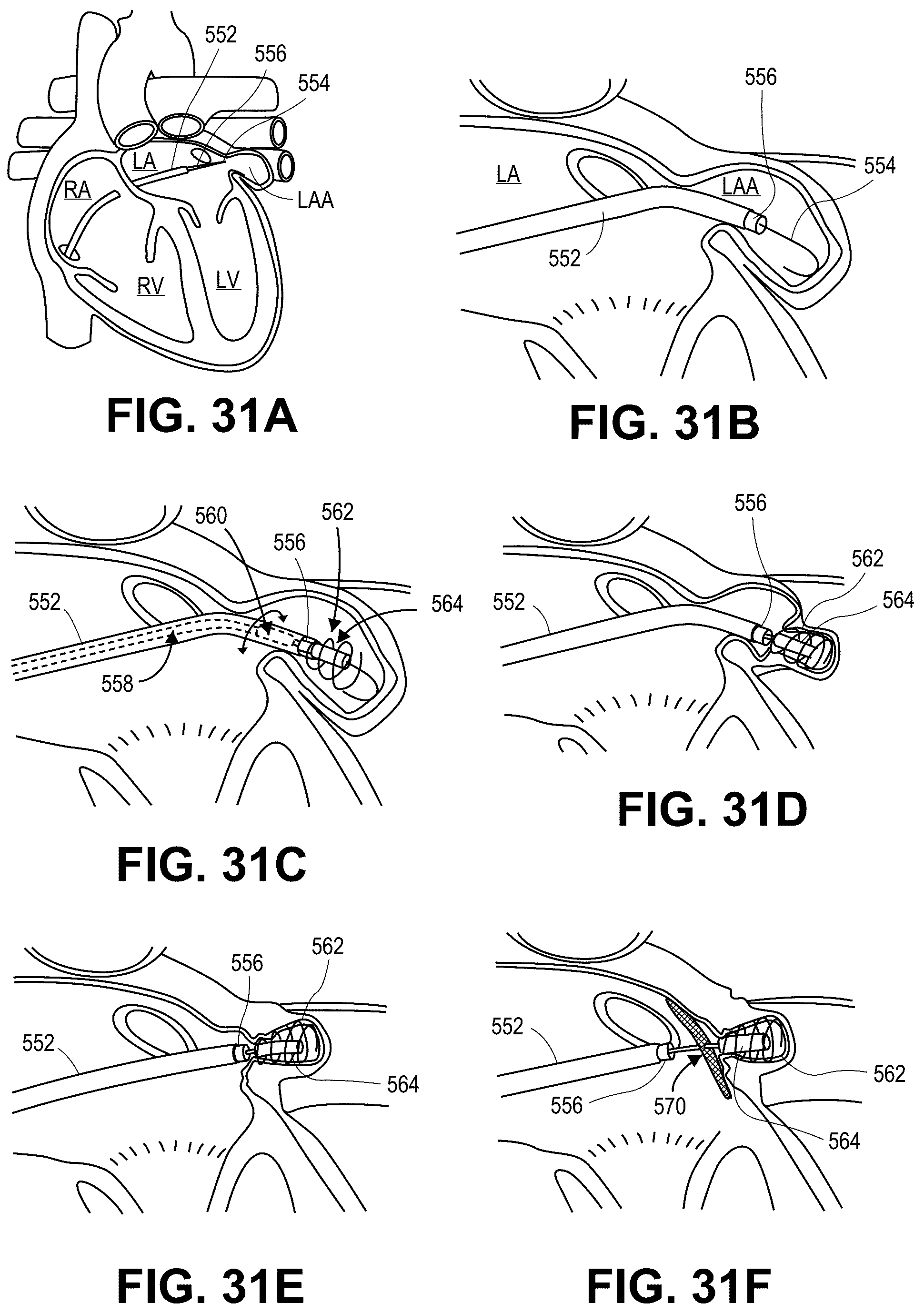 Patent US12090331 Figure 14 – Atrial appendage occlusion and arrhythmia treatment