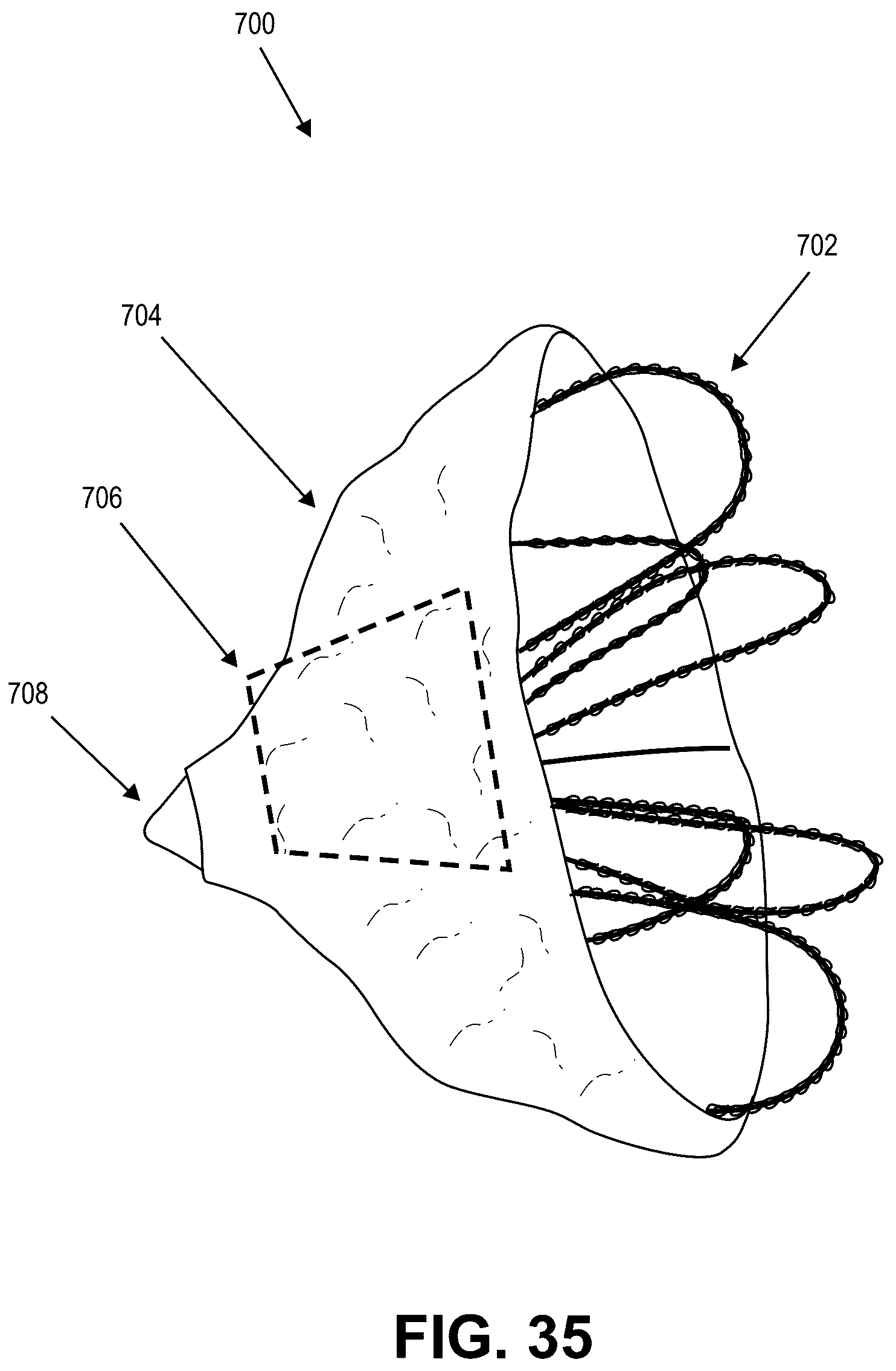 Patent US12090331 Figure 17 – Atrial appendage occlusion and arrhythmia treatment
