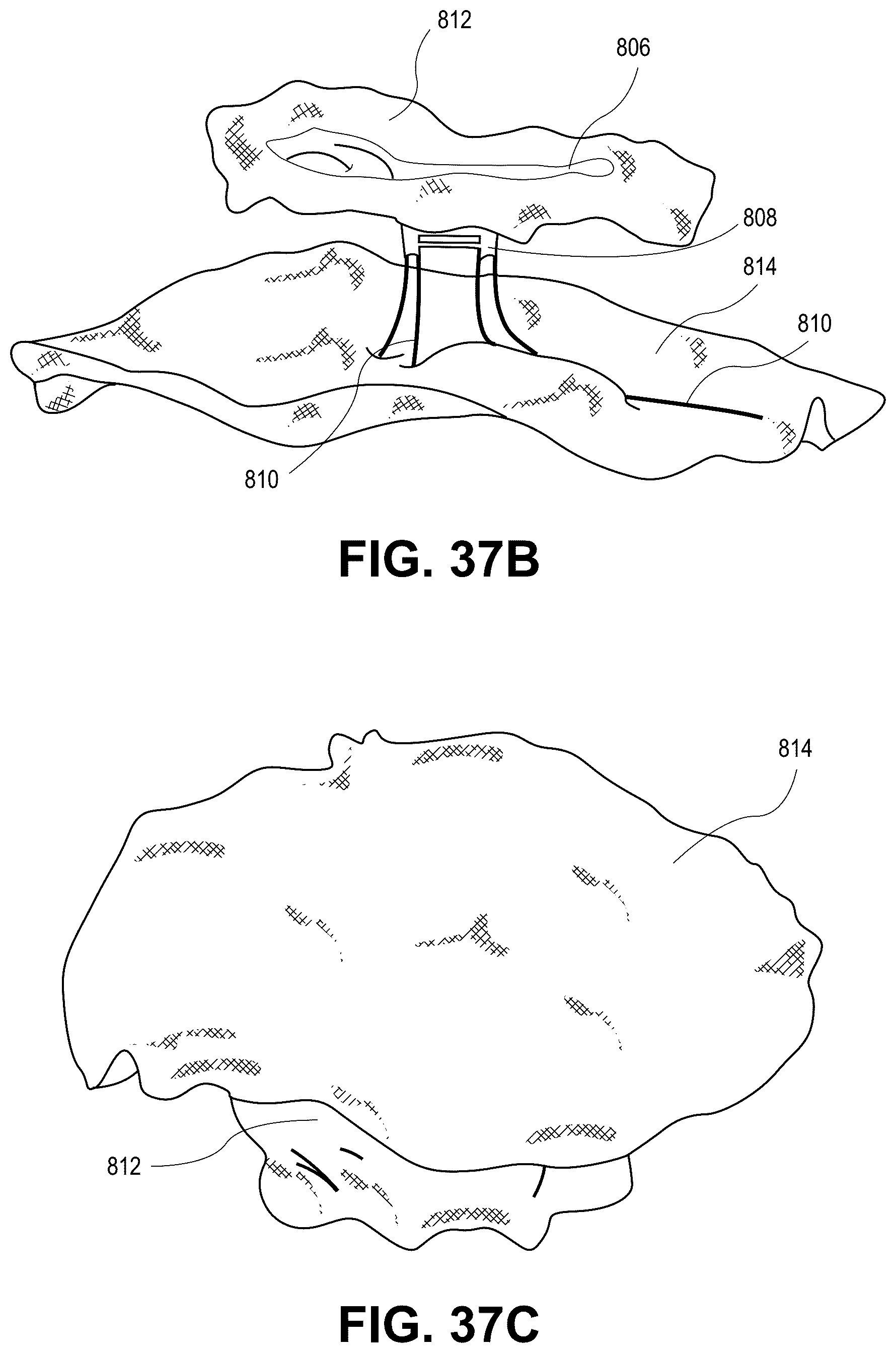 Patent US12090331 Figure 20 – Atrial appendage occlusion and arrhythmia treatment