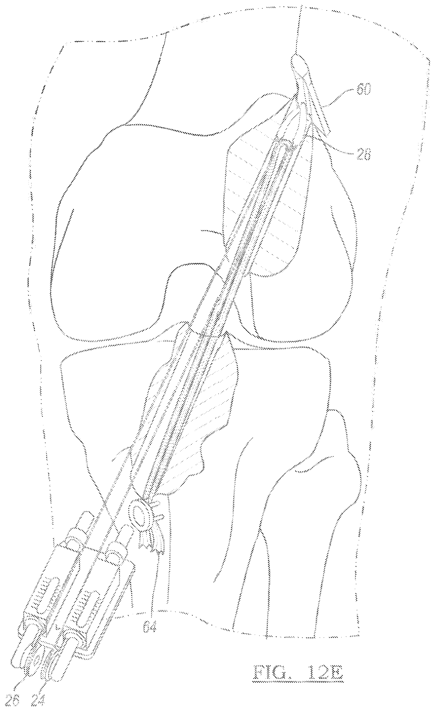 Patent US12096931 Figure 10 – Method and apparatus for coupling soft tissue to a bone