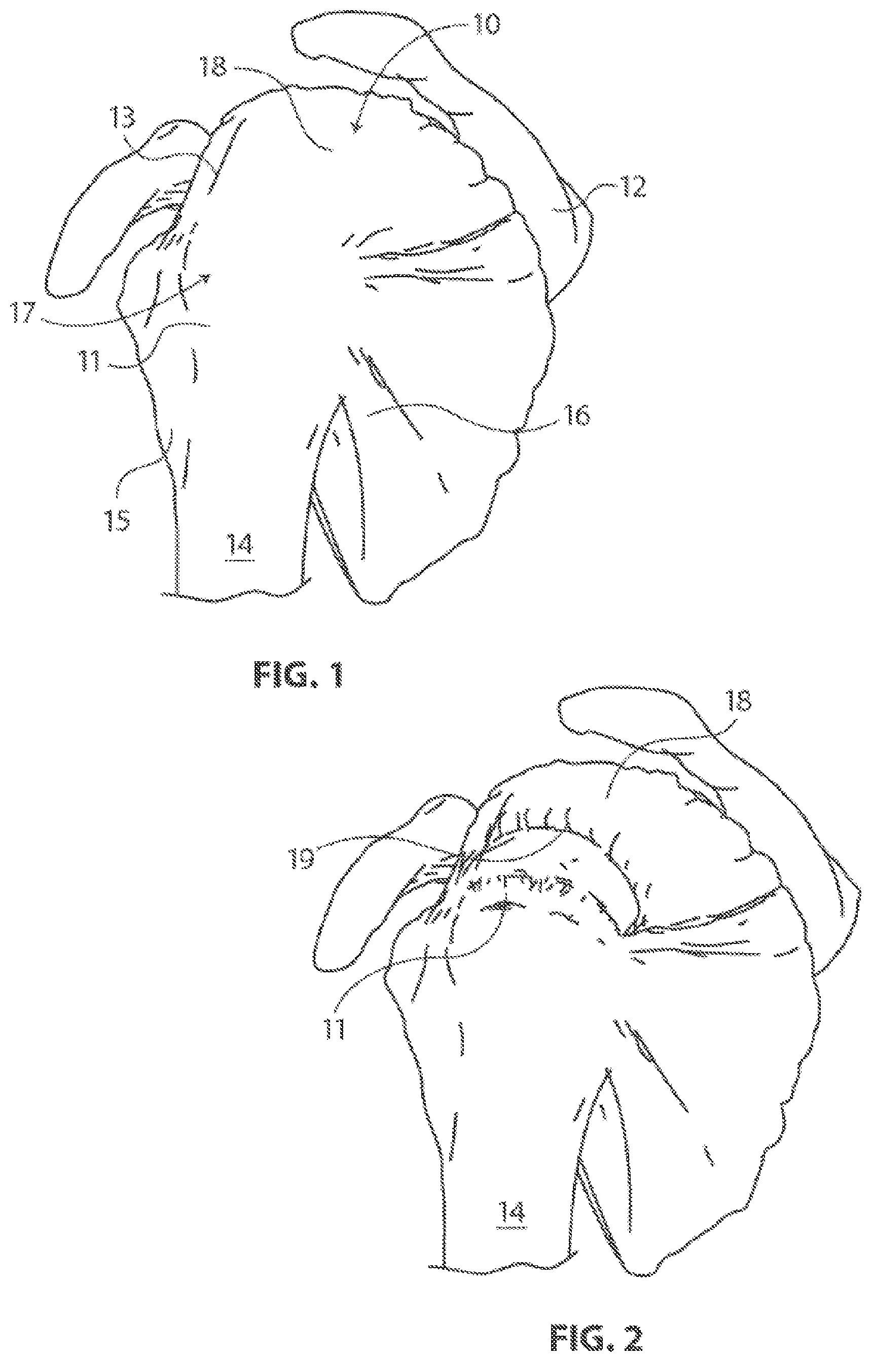 Patent US12096932 — Medical implant delivery system and related methods — Figure 1