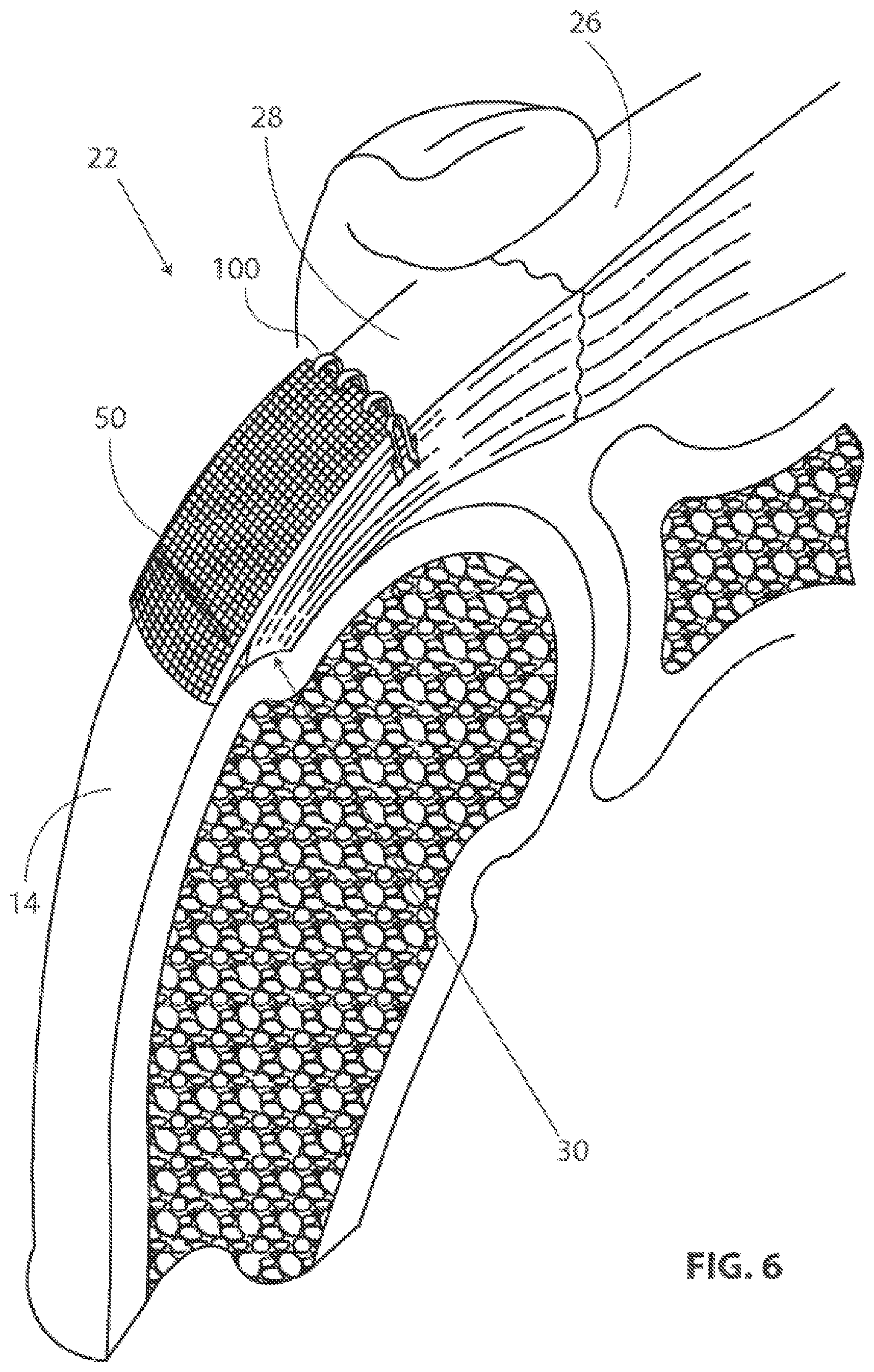 Patent US12096932 Figure 5 – Medical implant delivery system and related methods