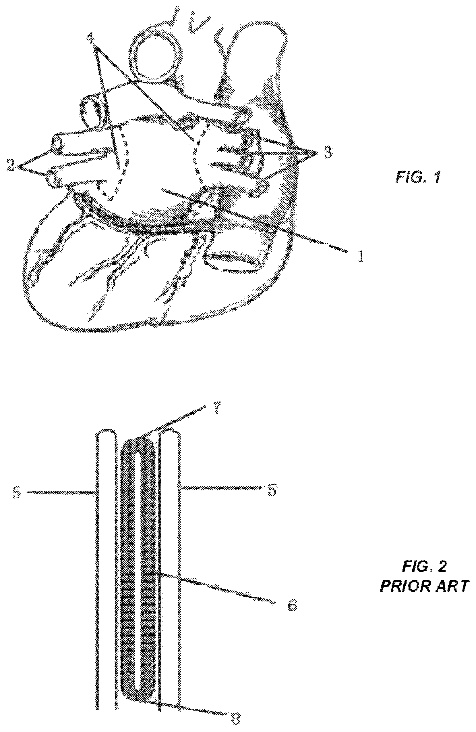 Patent US12096968 — Chemical ablation apparatus for treating arrhythmia — Figure 1