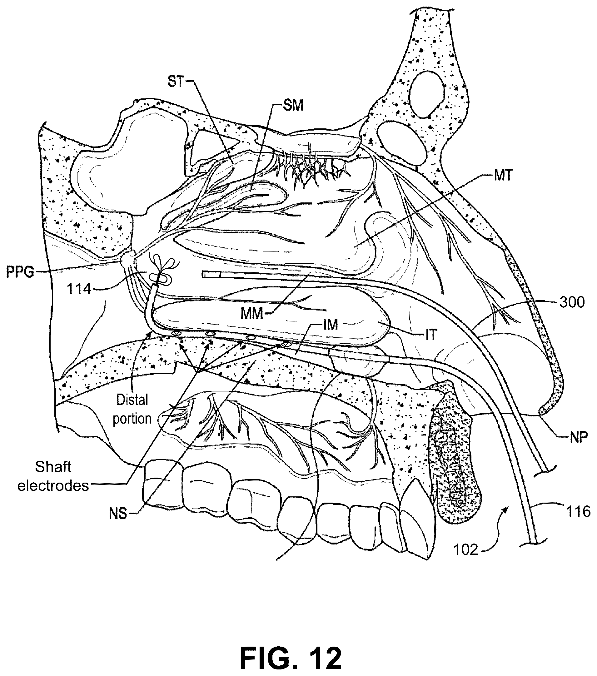 Patent US12096974 Figure 18 – Systems and methods for therapeutic nasal treatment using handheld device