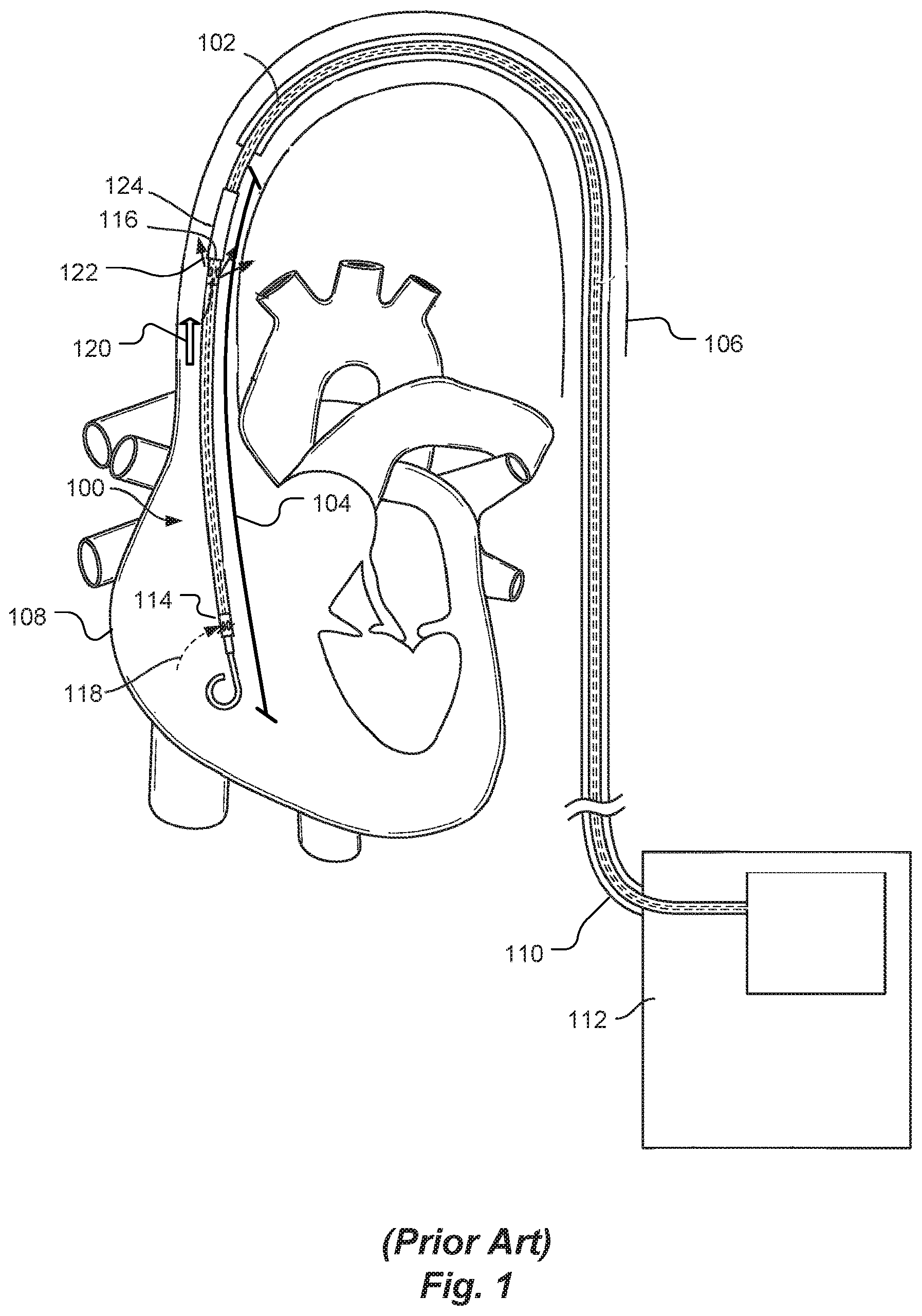 Patent US12097016 — Blood flow rate measurement system — Figure 1
