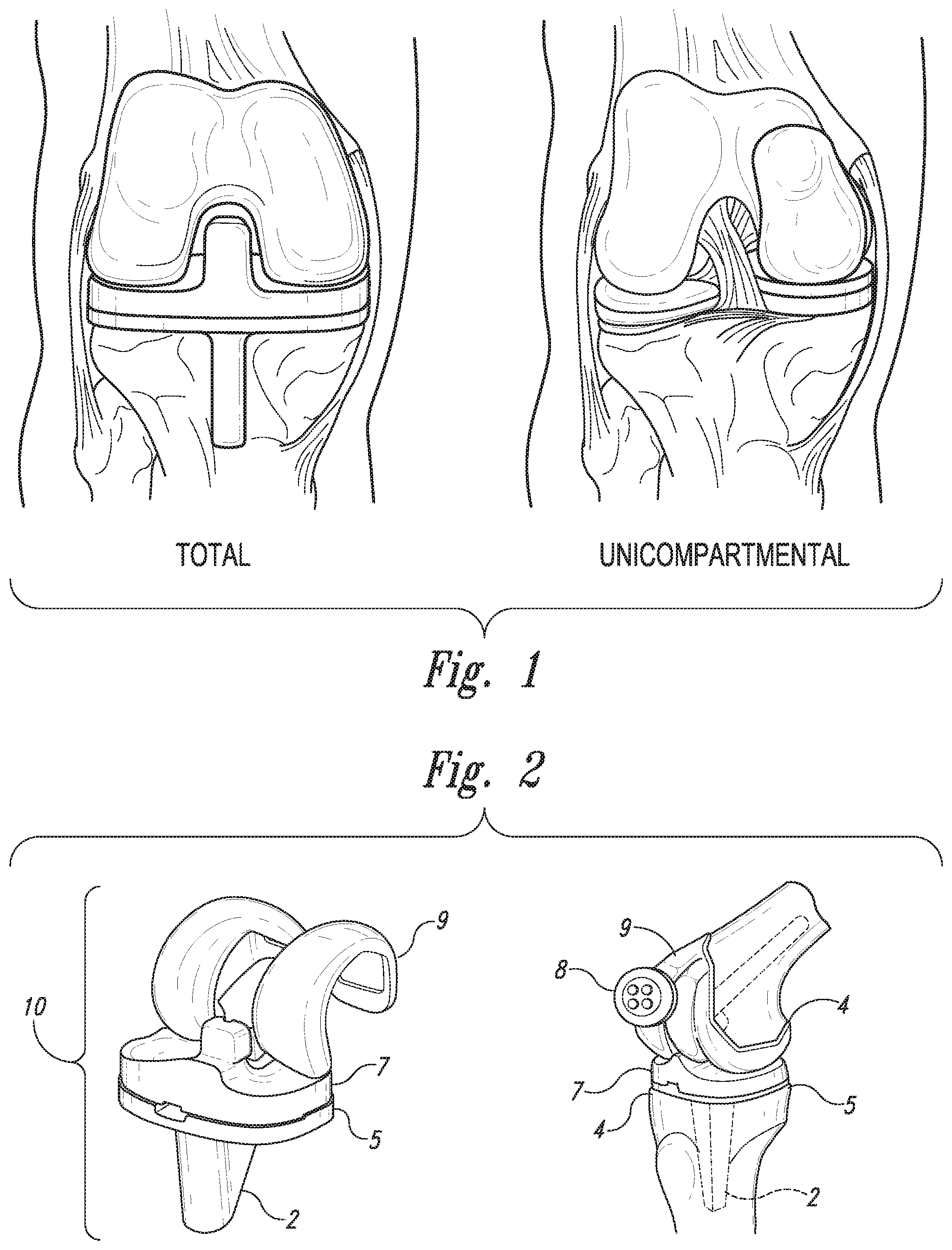 Patent US12097044 — Devices, systems and methods for monitoring knee replacements — Figure 1