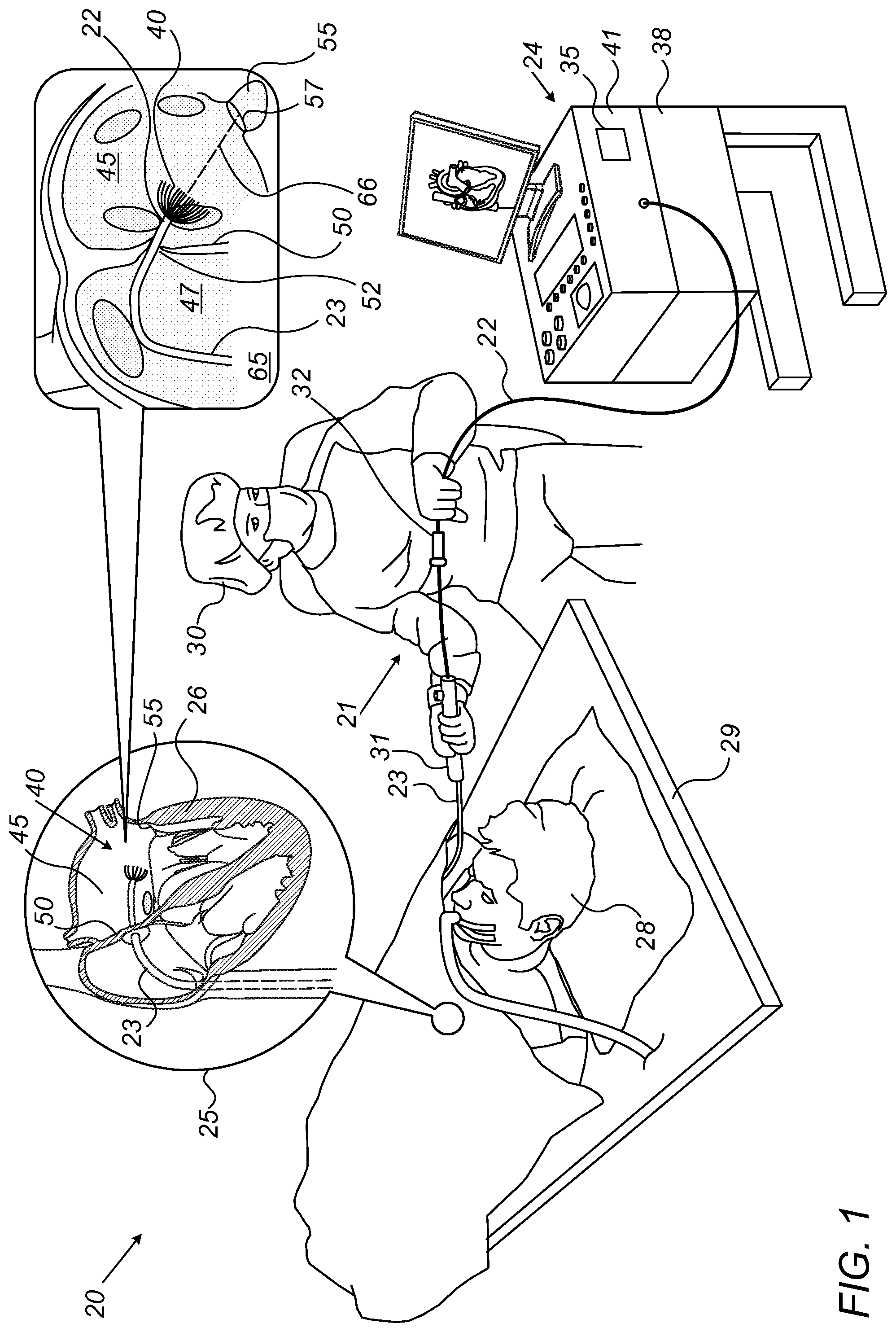 Patent US12097071 — Left atrial appendage (LAA) transseptal access point optimization — Figure 1