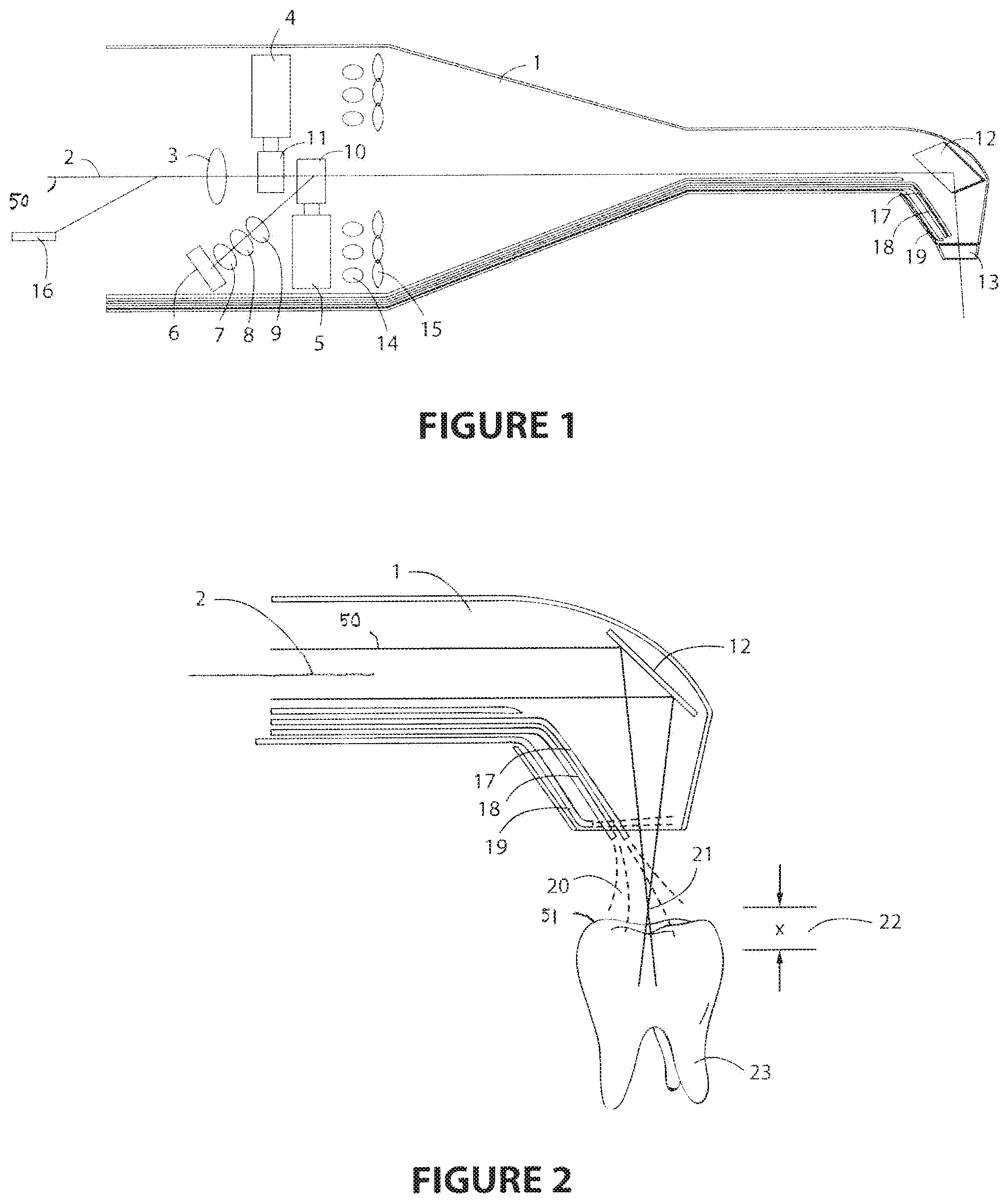 Patent US12097081 Figure 1 – Laser based computer controlled dental preparation system